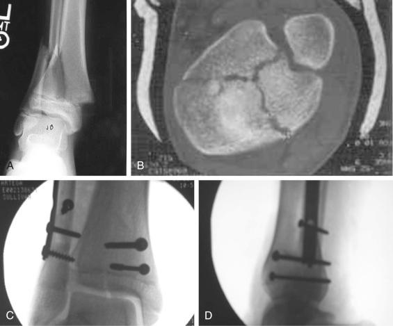 Fig. 138.8, (A) Anteroposterior view of a triplane and (B) computed tomography scan showing multiple fragments (C), (D). The position achieved by open reduction. (D) The position retained after hardware removal.