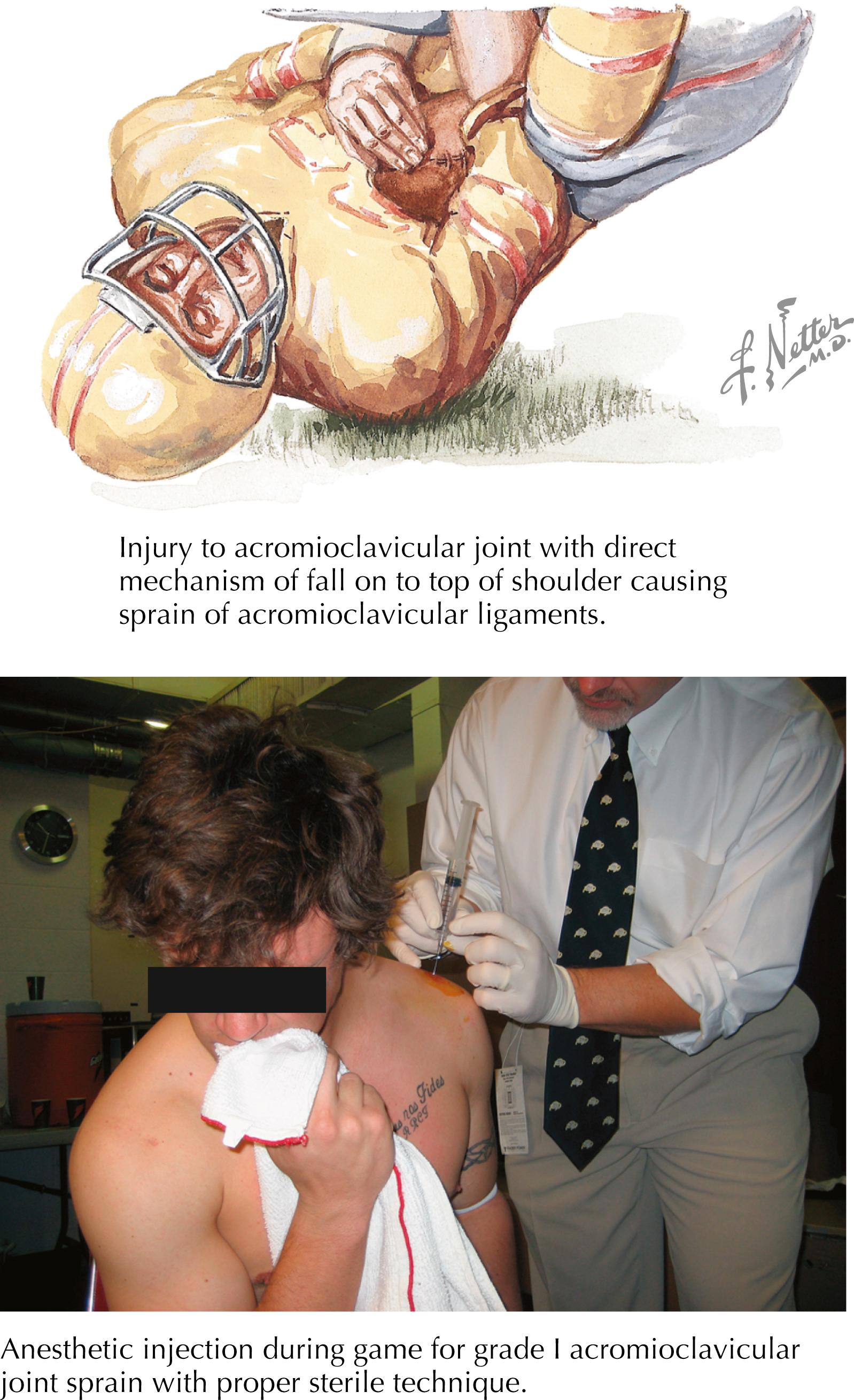 Figure 66.1, Acromioclavicular injury.