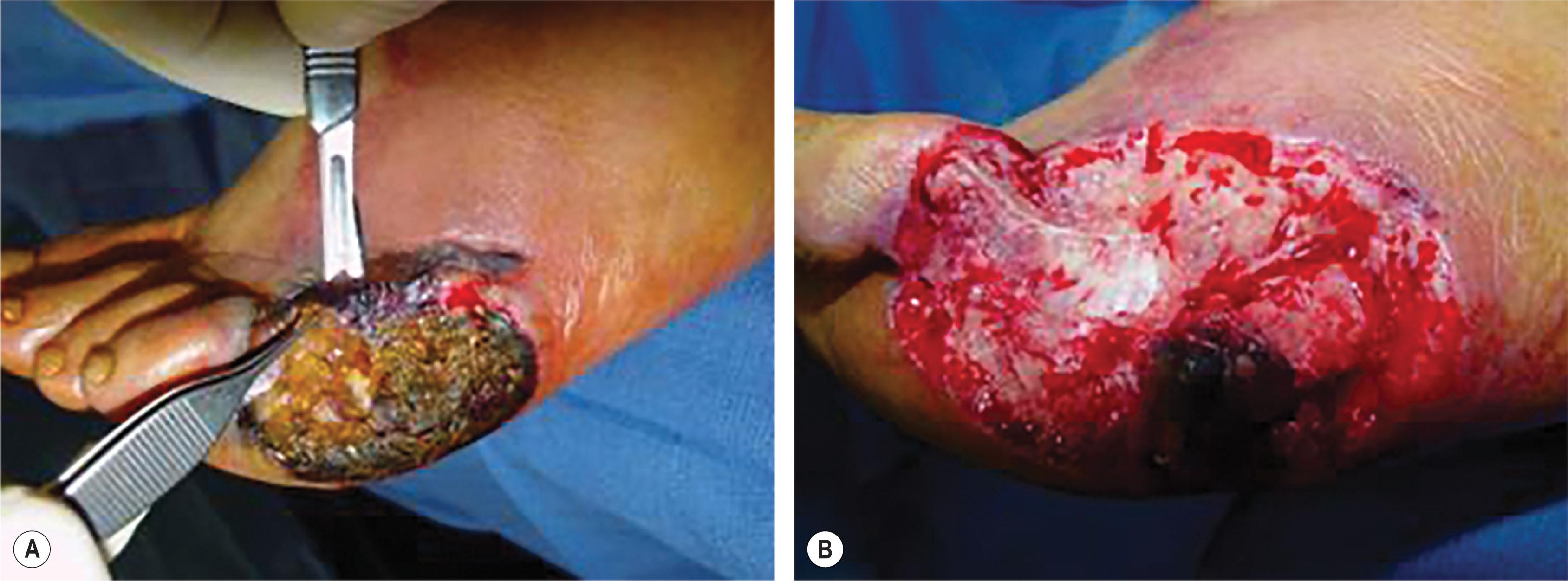 Figure 8.7, (A) Serial excision of a chronic and/or infected wound with a scalpel, rongeur, and saw to normal-color tissue (red, yellow, white) is critical to establishing a clean base. (B) The bone still needs to be resected, but the rest of the tissue has the desired color and texture. This is the technique to successfully convert a chronic wound into an acute wound.