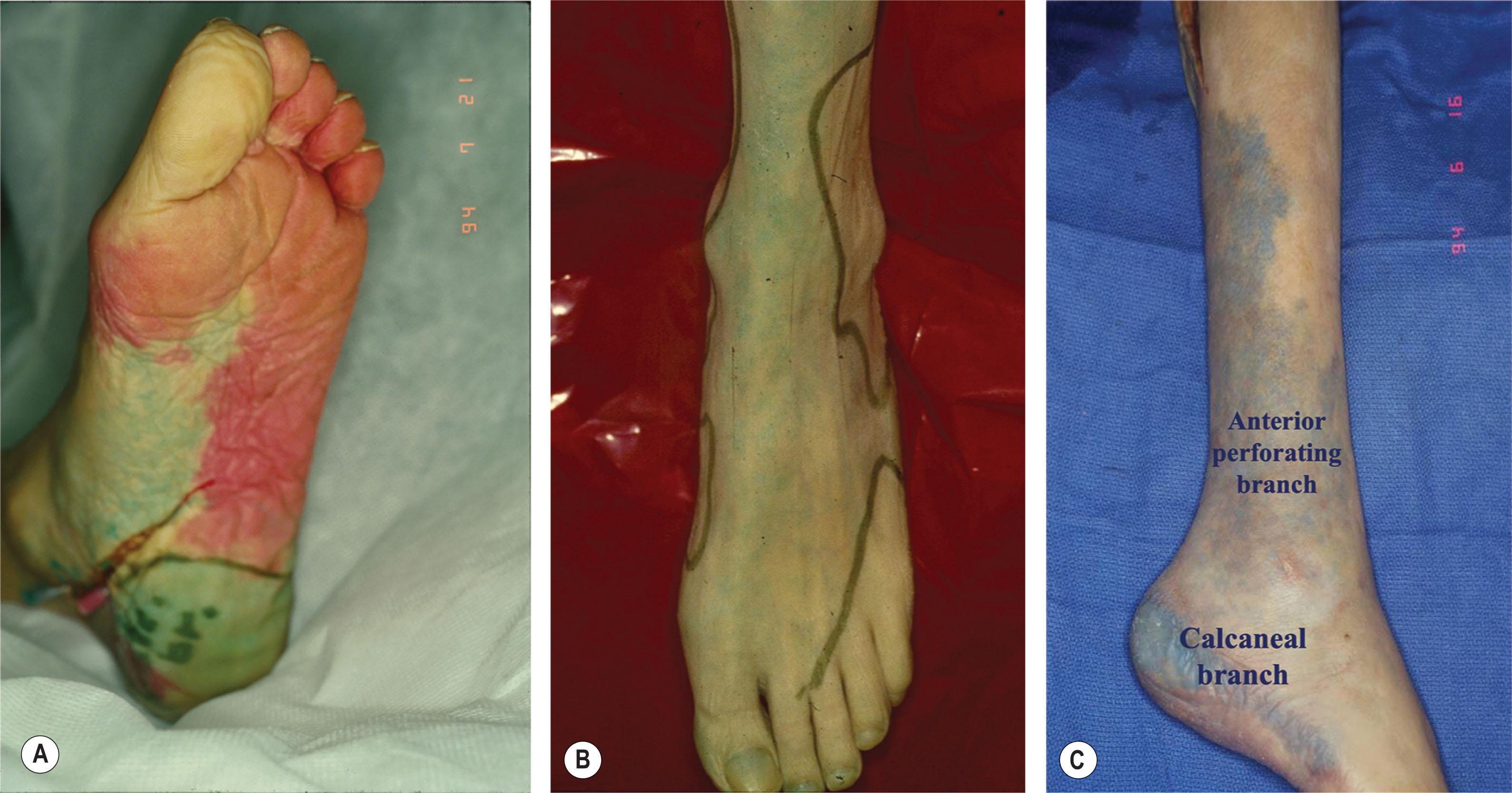 Figure 8.1, (A) Each of the three branches of the posterior tibial artery supply specific parts of the plantar foot: the calcaneal branch supplies the plantar heel, the medial plantar artery supplies the instep, and the lateral plantar artery supplies the rest of the plantar foot. Note that the lateral border of the calcaneal and lateral plantar branches end at the lateral glabrous junction. (B) The dorsalis pedis supplies the dorsal foot. (C) The calcaneal branch of the peroneal artery feeds the lateral heel, and the anterior perforating branch feeds the anterior lateral ankle.