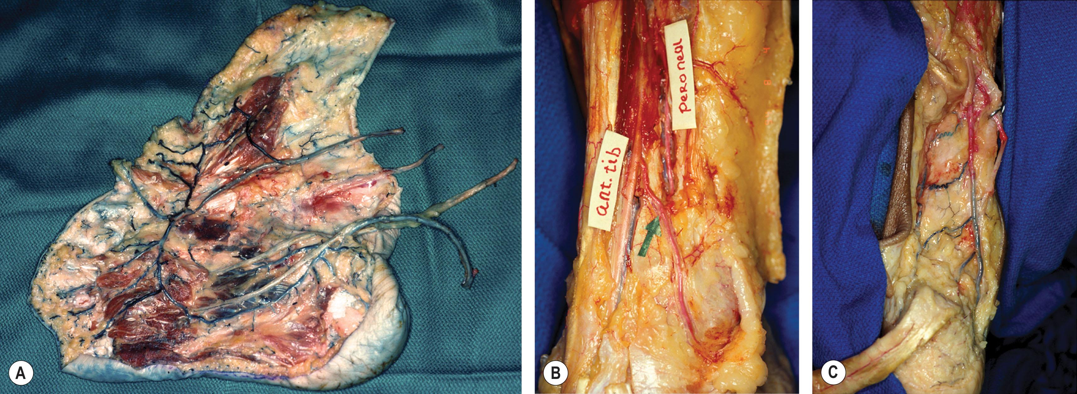 Figure 8.2, (A) The important arterial–arterial connection between the dorsalis pedis and lateral plantar artery via a patent arch between the first and second proximal metatarsal. In the specimen, the bones have been removed. (B) The arterial–arterial connection between the anterior perforating branch of the peroneal with the anterior tibial artery via the lateral malleolar artery. (C) The arterial–arterial connection between the posterior tibial and peroneal arteries at the level of the ankle.