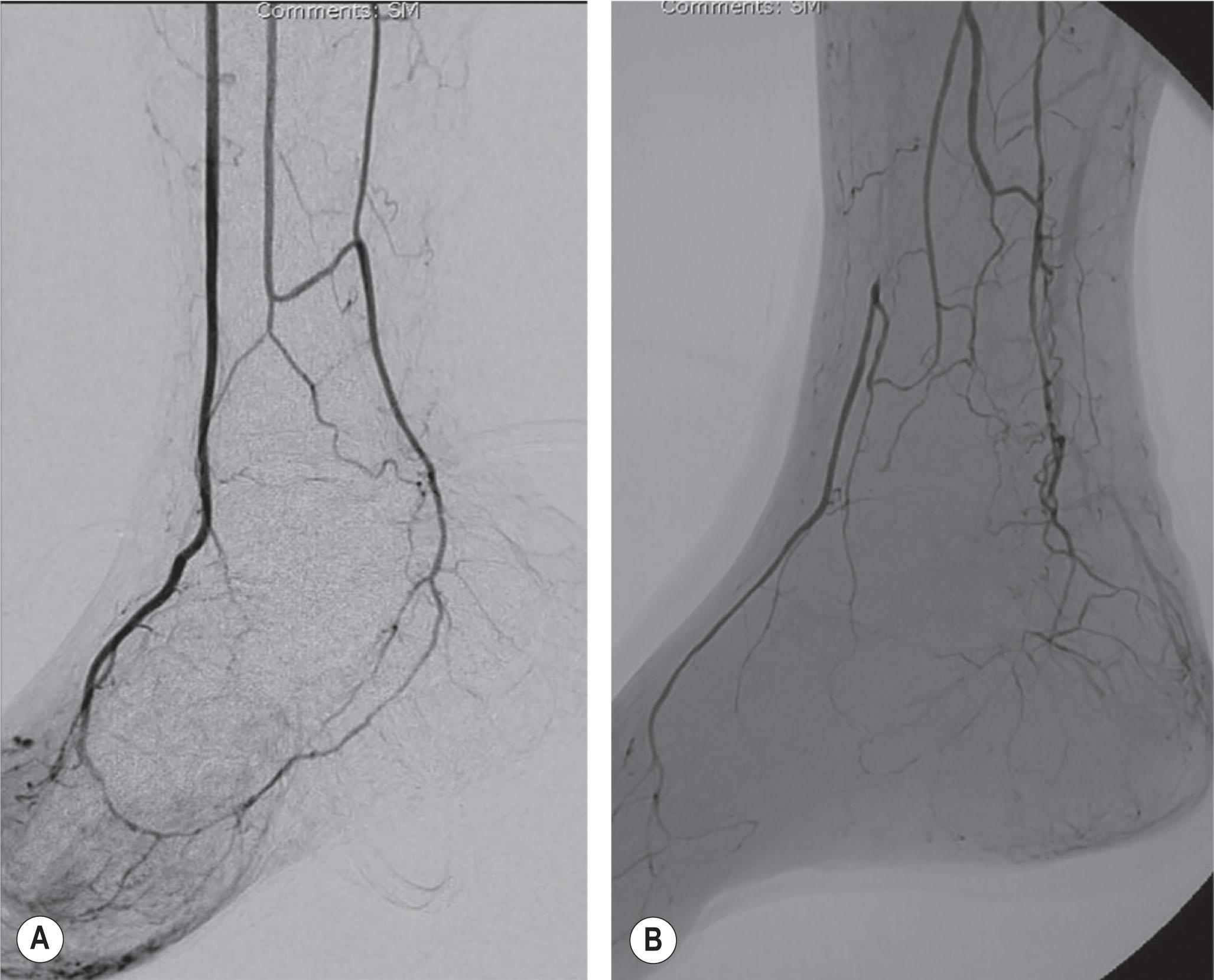 Figure 8.3, (A) The angiogram picture of the three important arterial–arterial connections. (B) The peroneal artery can restore blood flow to both an occluded anterior tibial artery and a severely diseased posterior tibial artery via the arterial–arterial connections.