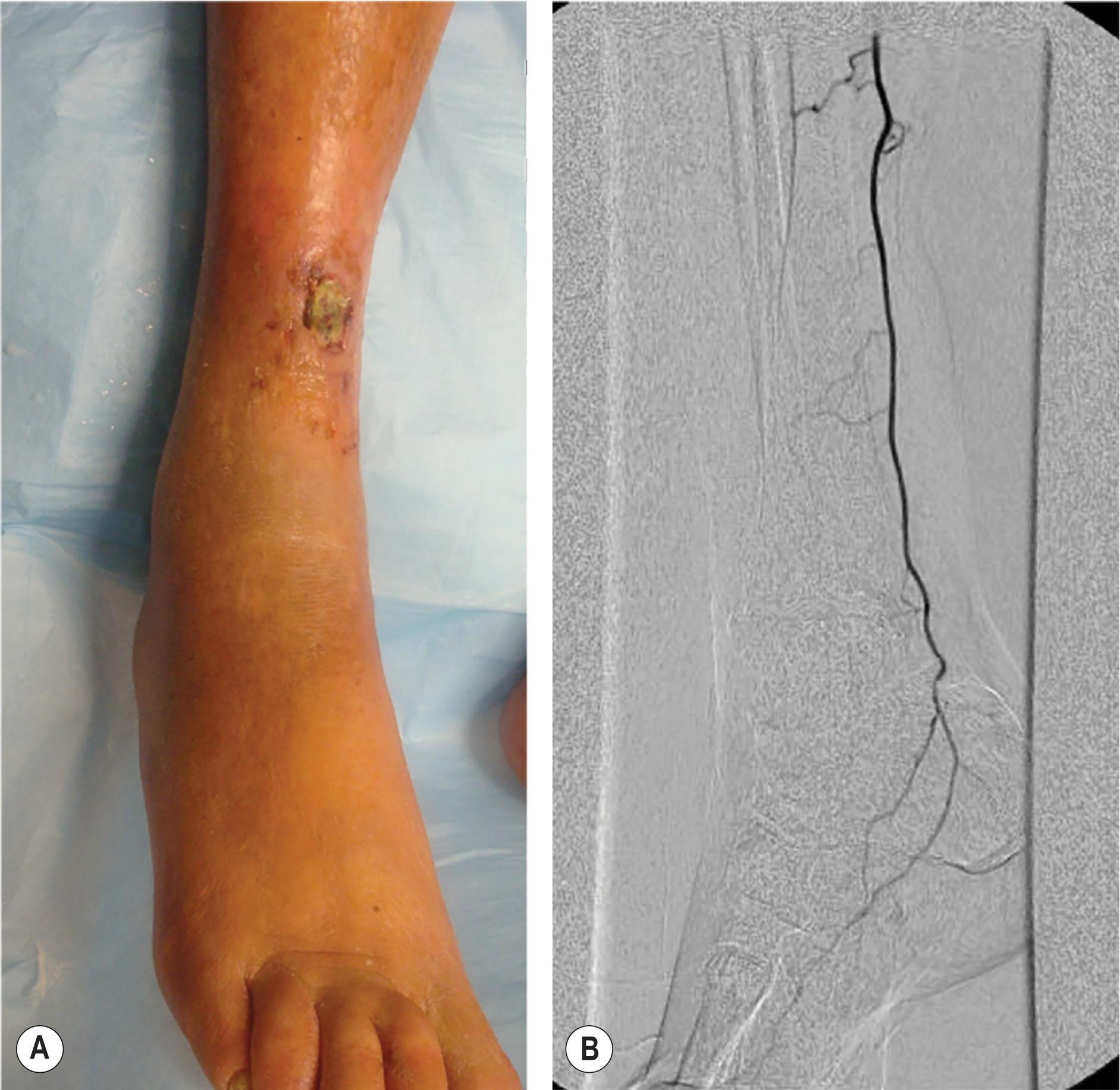 Figure 8.4, (A) An ulcer over the distal anterior tibial artery angiosome that is not healing despite a palpable posterior tibial pulse. (B) Angiogram shows that both the anterior tibial artery and the peroneal artery are occluded.