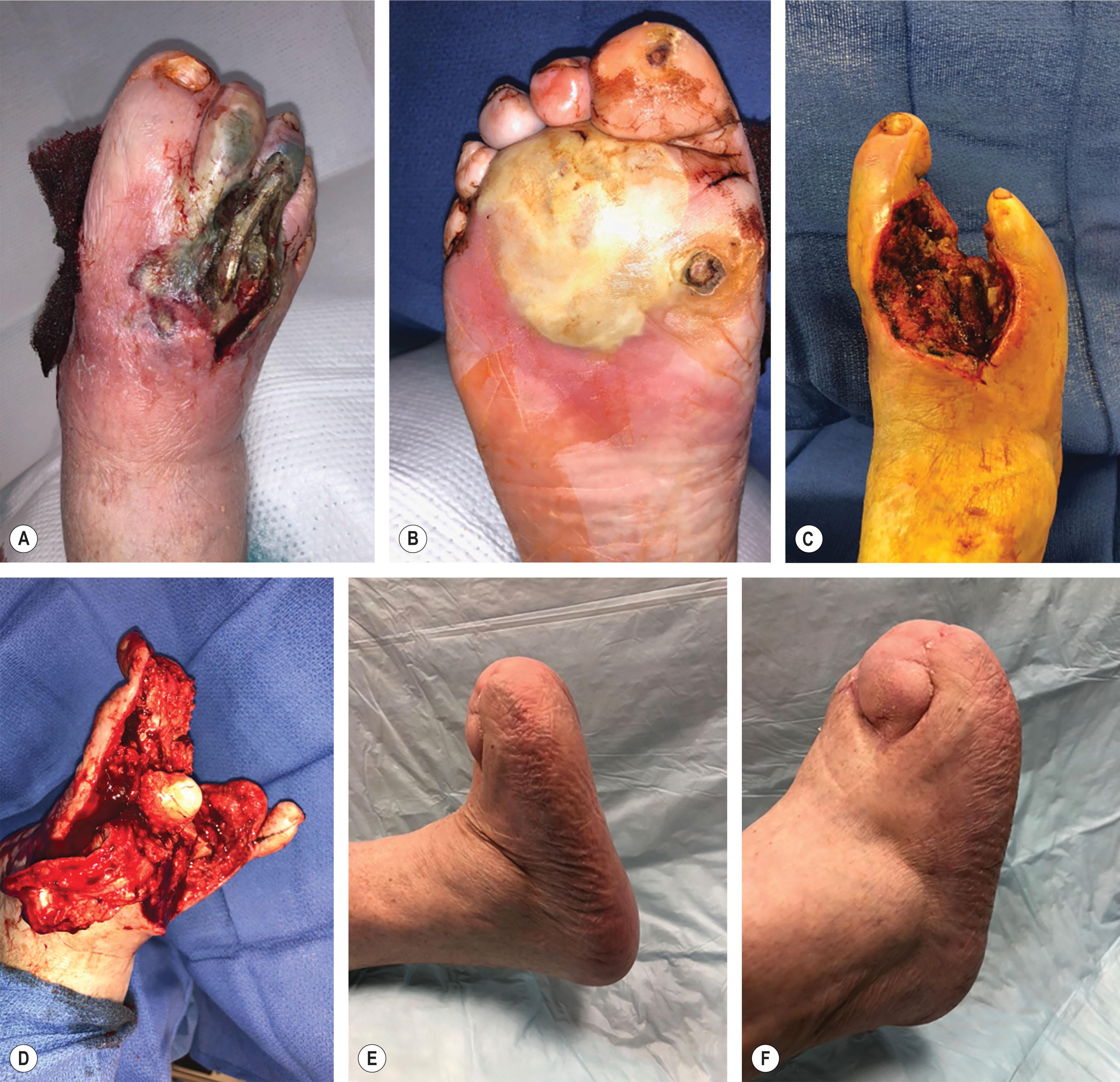 Figure 8.5, (A,B) Patient presented with a rapidly expanding necrotizing fasciitis from an incision in the forefoot. The patient was taken to the operating room immediately, and all of the necrotic tissue was excised. Despite very aggressive debridement, the first and 5th toes were spared (C) . The patient underwent serial debridements until the tissue was culture negative. (D) A transmetatarsal amputation was performed using the soft tissue of spared hallux and 5th toe and Achilles tendon lengthening. (E,F) The patient’s limb was salvaged at a very functional long transmetatarsal amputation level.