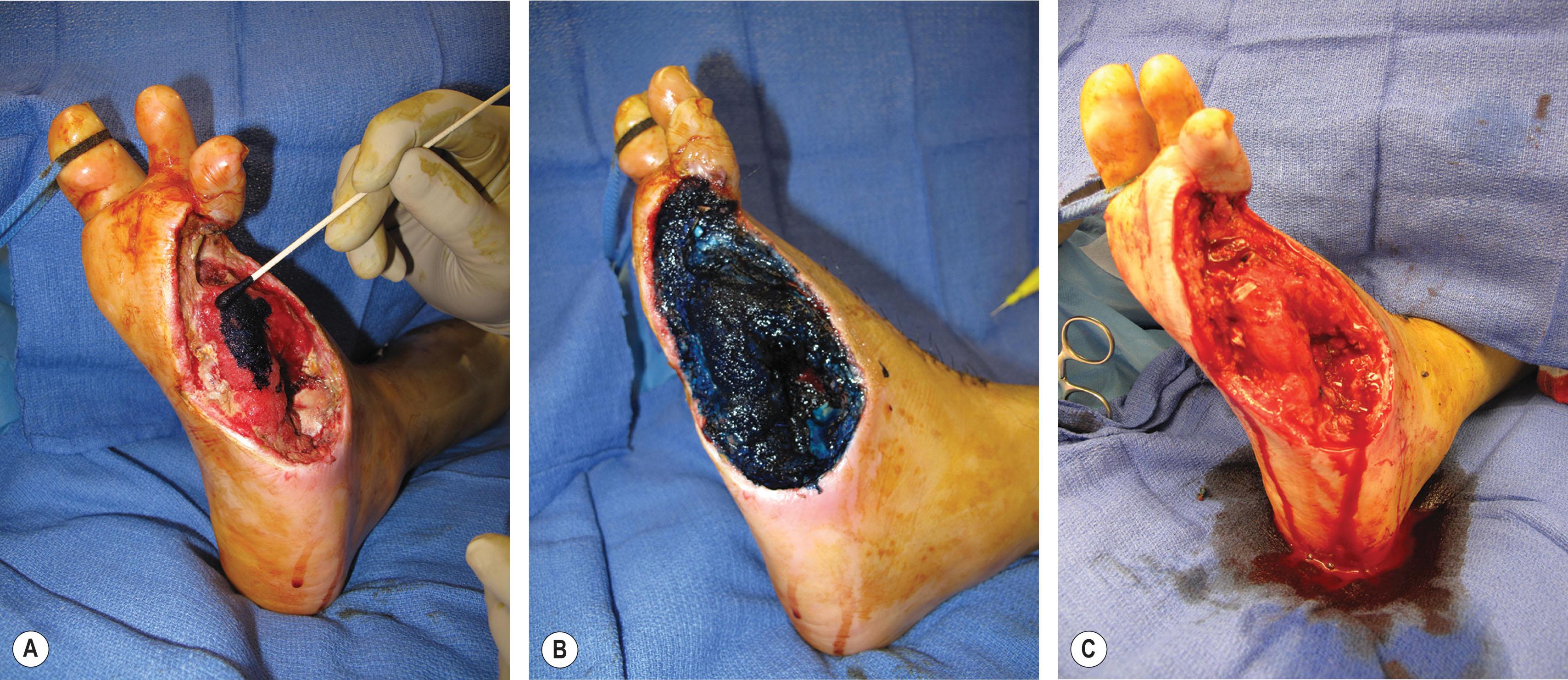 Figure 8.6, Applying blue dye (methylene blue or surgical marker) to paint the entire surface of the wound so that no area is missed during debridement is critical for removal of all surface biofilm. A Q-tip soaked in blue dye applies blue dye to the wound (A) until the entire surface is painted (B) . The wound is excisionally debrided until there is no residual dye post debridement (C) .