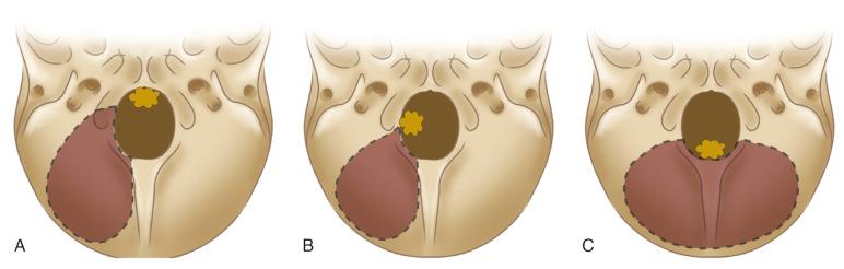 Figure 38.1, The selection of the surgical approach can be done with the help of the classification system of Bruneau and George (2010). For anterior and anterolateral foramen magnum meningiomas a far lateral trasncondylar (A) or a far lateral apporach (B) are appropriate. For posterior foramen magnum meningiomas a posterior suboccipital approach may be preferred (C).