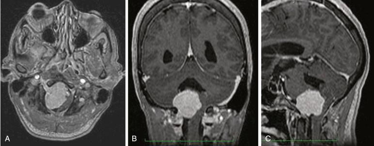 Figure 38.2, Brain MRI axial (A), coronal (B) and sagittal (C) views showing a foramen magnum meningioma with contrast enhancement.