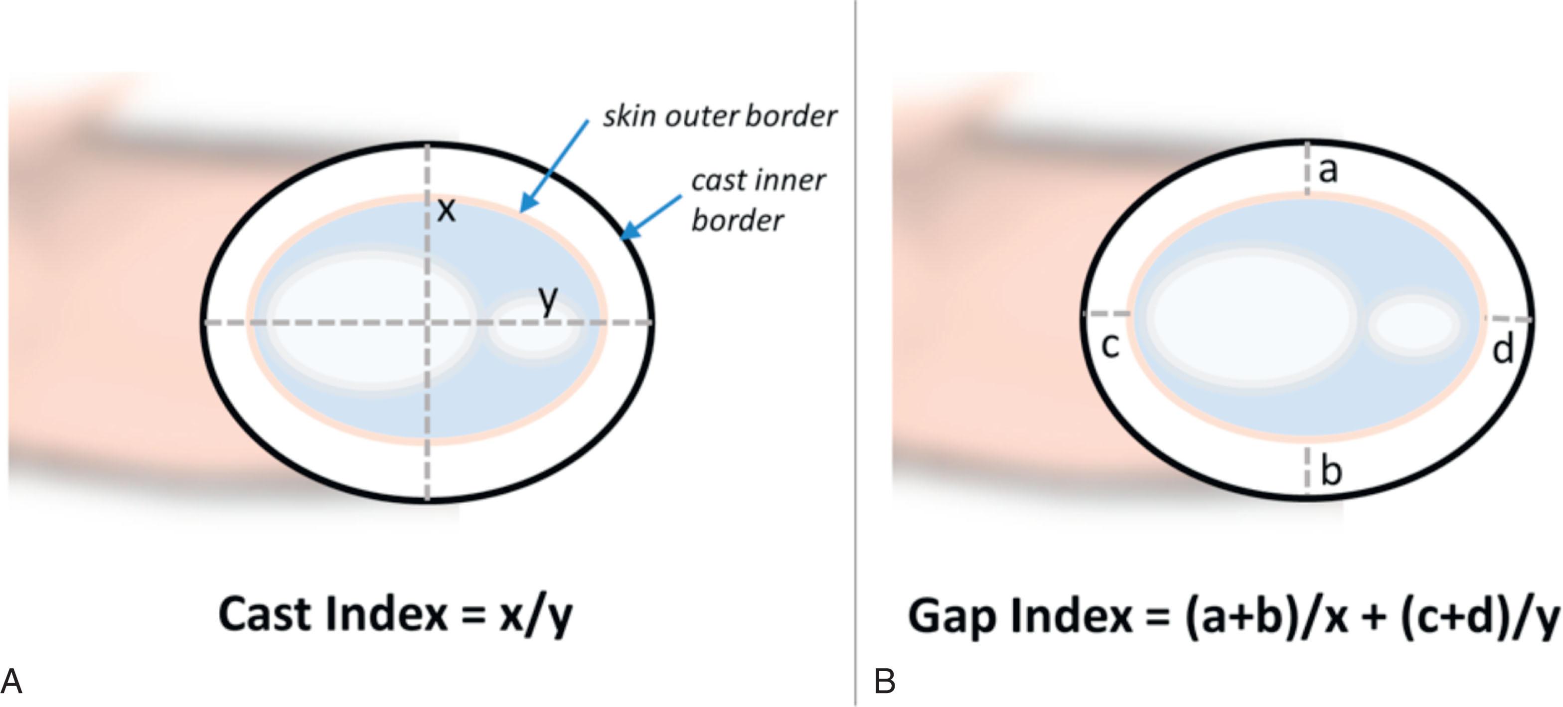 Fig. 5.1, Cast Index and Gap Index. Cast quality and propensity for loss of fracture reduction can be assessed using several indices. The cast index (A) divides the diameter of the inner border of the cast on the lateral view by the diameter of the inner border of the cast on the anteroposterior view at the level of the fracture, revealing a decimal. A good prognostic indicator for maintenance of reduction is considered to be under 0.8. The gap index (B) measures the sum of the diameters representing the gap between the skin and the cast on either side of the fracture, dividing this by the corresponding diameter between the inner borders of the cast in the corresponding plane. The sum of the anteroposterior and lateral values yields a decimal. A good prognostic indicator for maintenance of reduction is considered less than 0.15.