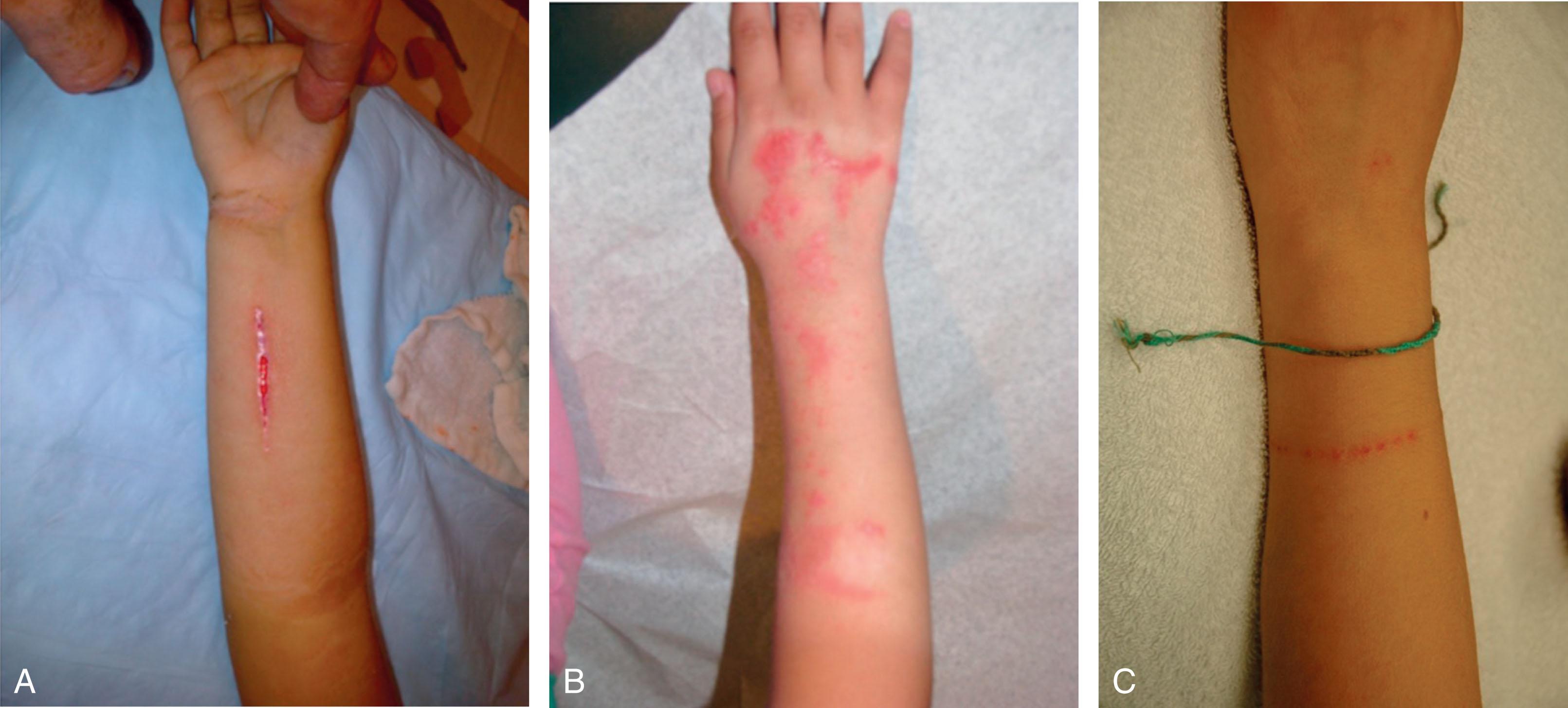 Fig. 5.3, Complications After Cast Application. (A) Burns resulting from improper cast saw technique. (B) Skin breakdown from prolonged water exposure to the cast padding. (C) Pressure sore from a foreign object (bracelet) between the cast and skin.