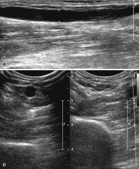 Figure 64-2, B-mode ultrasound is used to visualize the cephalic vein in the longitudinal view ( A ) and the basilic vein in the transverse view ( B ) with compression (right) and without compression (left).