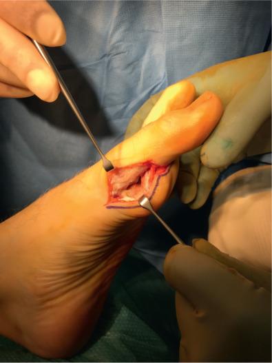 Fig. 121.3, Plantar medial incision to tibial sesamoid.