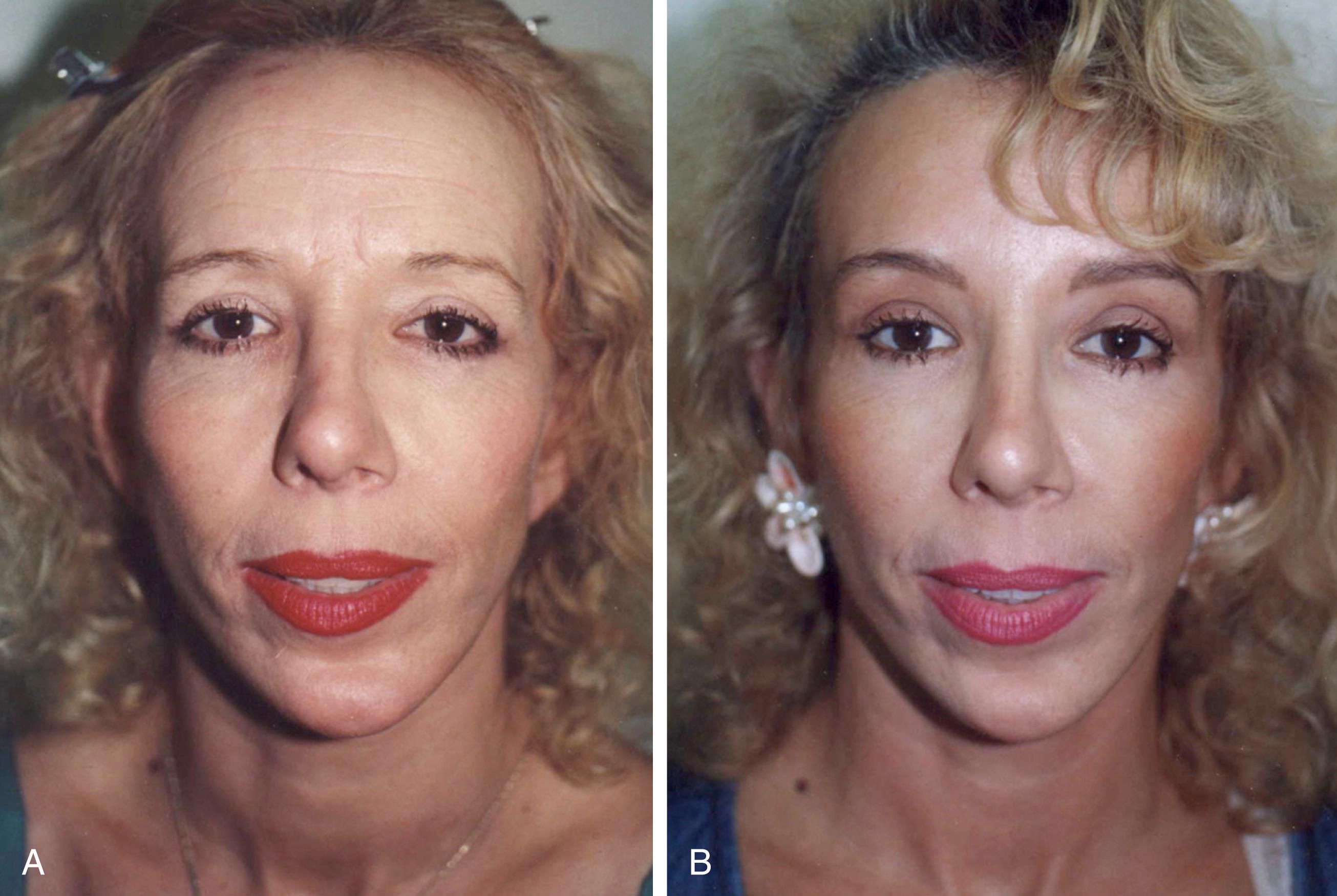Fig. 63.1, Changes in the aging forehead . A patient seen before and after foreheadplasty. She has undergone previous facelift, upper and lower blepharoplasties, and chin implant placement performed by an unknown surgeon. A forehead lift was not performed. (A) Typical changes seen in the aging forehead include: eyebrow ptosis, lateral brow ptosis, pseudoblepharochalasis, glabellar “frown lines,” transverse forehead creases, corrugator muscle hypertrophy, transverse upper nasal creases, and hairline recession. The patient’s upper face appears older than her lower face and she has a “young face–old forehead” appearance. (B) The same patient after foreheadplasty. No eyelid or other surgery has been performed. The patient’s eyebrows can be seen to have better position and configuration and the brow shape imparts a more alert, attractive, and feminine appearance. While preoperatively it might appear that excess skin is present on her upper eyelids repositioning her brows has revealed that this was pseudoblepharochalasis and that her upper lids are actually short on skin. Glabellar frown lines and transverse forehead crease have been effectively treated creating a less tense and more agreeable appearance. The frontal hairline has been lowered to a more youthful and esthetic position, creating better balance with other facial features.