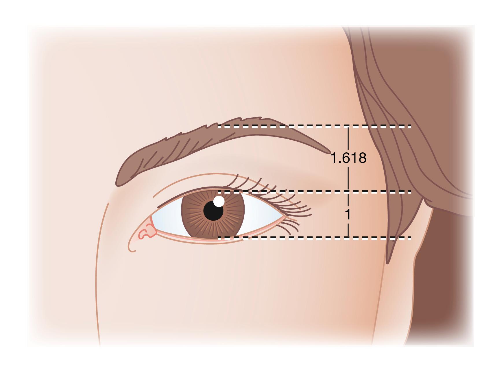 Fig. 63.11, The “golden eyebrow.” An analysis of the attractive upper face will show that the aperture of the eye (the vertical distance between the upper and lower eyelids in forward gaze) and the distance between the margin of the upper lid and arch of the eyebrow are related to one another by the “golden proportion.” Because the size of the globe and the height of the palpebral aperture will vary from patient to patient, so too must the height of the attractively positioned eyebrow.