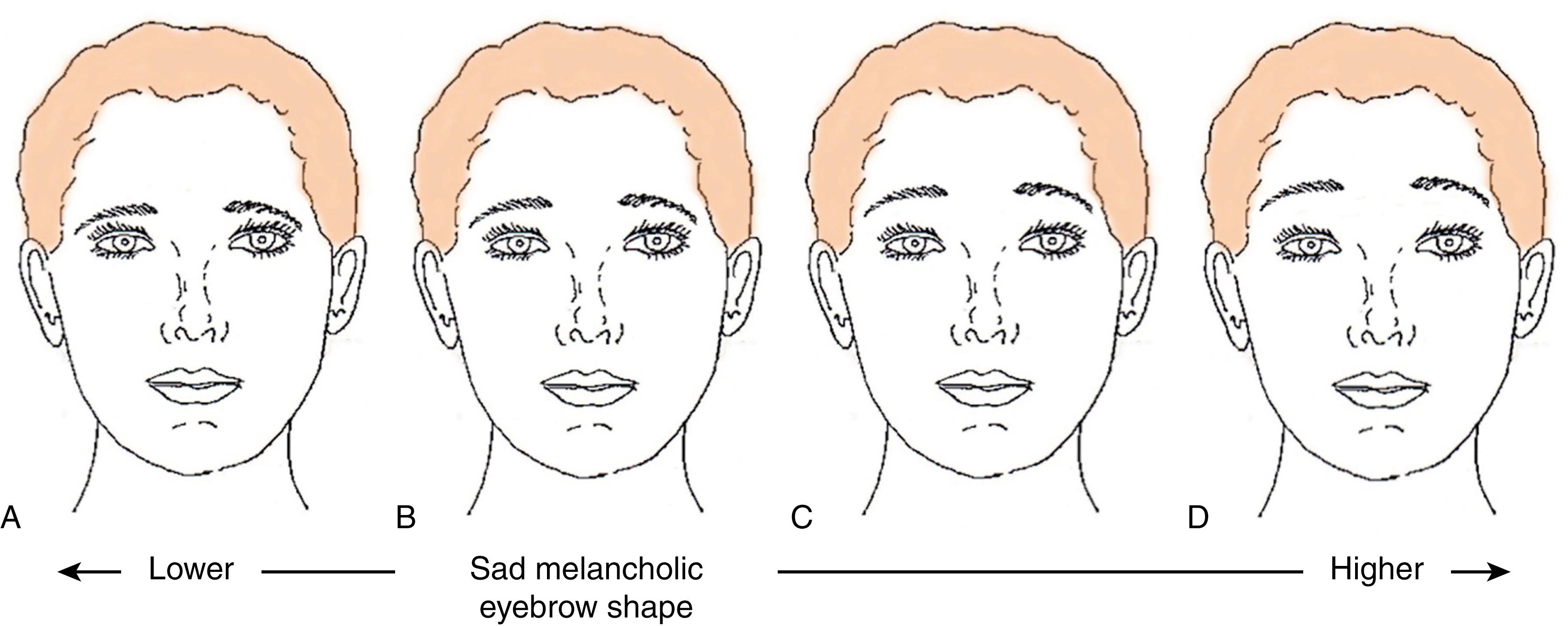 Fig. 63.15, The effect of brow height when eyebrow shape is poor . Shown in (B) a prototypical face with sad, melancholic shape and neutral position. If the eyebrow is lowered (A) a sad, melancholic appearance is still present. When the eyebrow is raised (C), even when raised aggressively (D), a sad, melancholic appearance is arguably still present. In fact, all faces throughout the spectrum shown arguably appear unesthetic and inconsistent with an attractive appearance, and one can conclude that if eyebrow shape is poor, the face will appear unattractive regardless of eyebrow height .