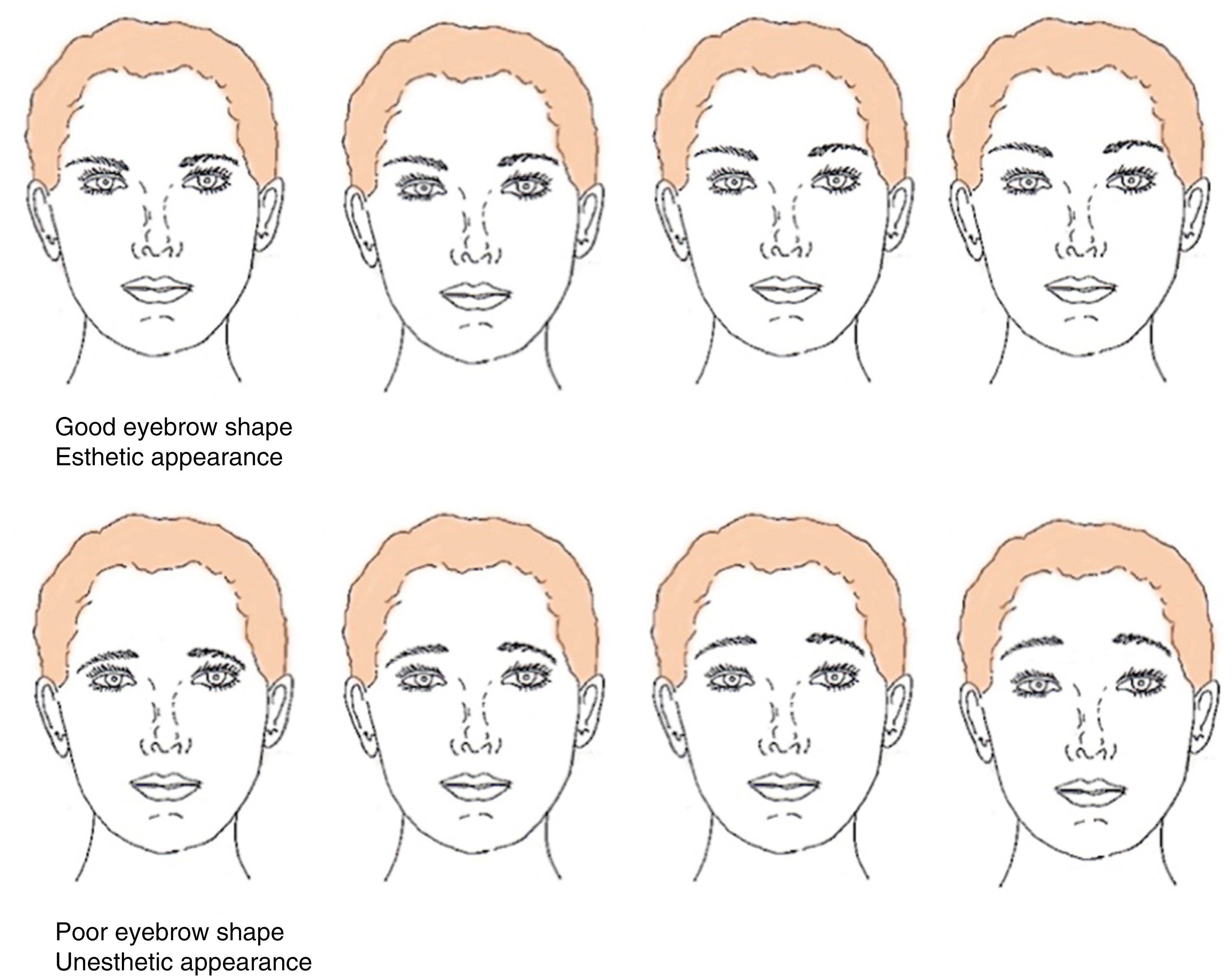 Fig. 63.16, Summary of eyebrow shape and appearance. If eyebrow shape is good an esthetic appearance will be present regardless of height, but if shape is poor an unesthetic appearance will be present regardless of eyebrow height. Therefore shape supersedes height in importance in establishing an esthetic appearance. The surgical and artistic goal is to “tilt” the eyebrow – not “lift” it. If a foreheadplasty procedure does not produce good eyebrow shape an attractive appearance will not be obtained.