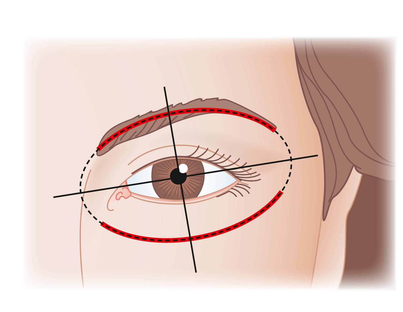 Fig. 63.17, Orbital oval analysis is a method used by estheticians, make-up professionals, and artists to design and draw attractive and esthetically pleasing eyebrows. Orbital oval analysis stipulates that the eyebrow should be situated so that the eye sits in the center of an oval defined by the lid–cheek junction and the eyebrow.