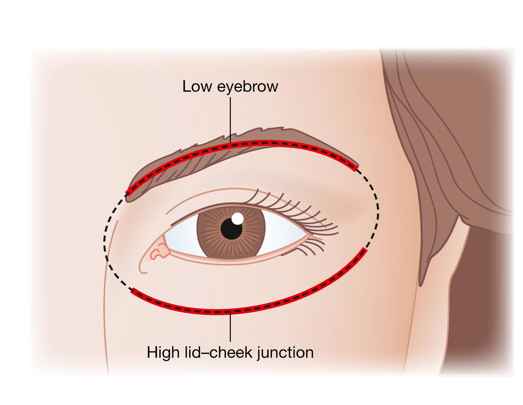 Fig. 63.18, Orbital oval analysis – young face . When the lid–cheek junction is high, as it is typically on the young attractive face, a lower eyebrow position will be necessary to maintain the orbital oval and esthetic balance. This may explain why a low eyebrow looks better and may be artistically appropriate on a young face, and why a higher eyebrow looks better on a mature face (see Fig. 63.19 ).