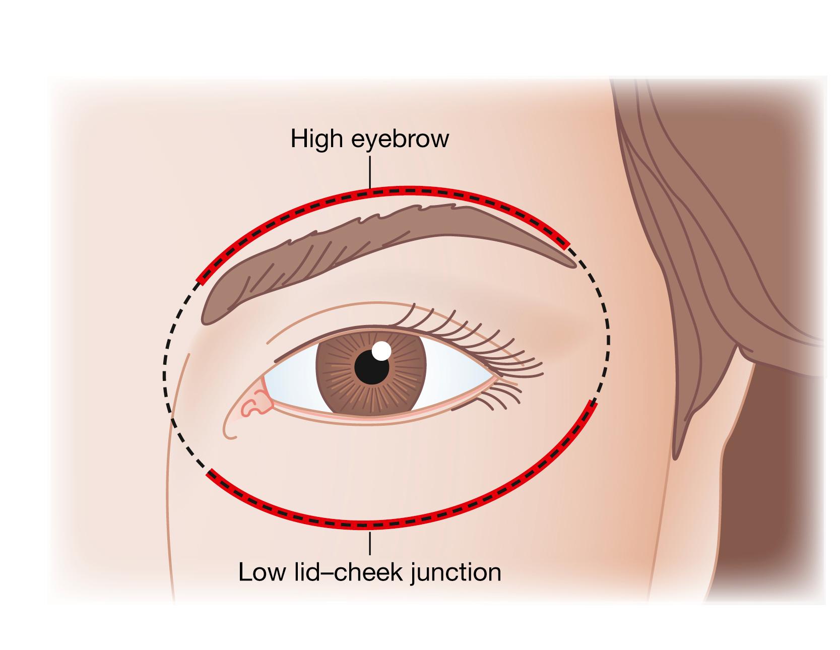 Fig. 63.19, Orbital oval analysis – mature face . When the lid–cheek junction is low, as it is typically on the mature attractive face, a higher eyebrow position will be necessary to maintain the orbital oval and esthetic balance. This may explain why a high eyebrow looks better and may be artistically appropriate on an older face, and why a lower eyebrow looks better on a young face (see Fig. 63.18 ).