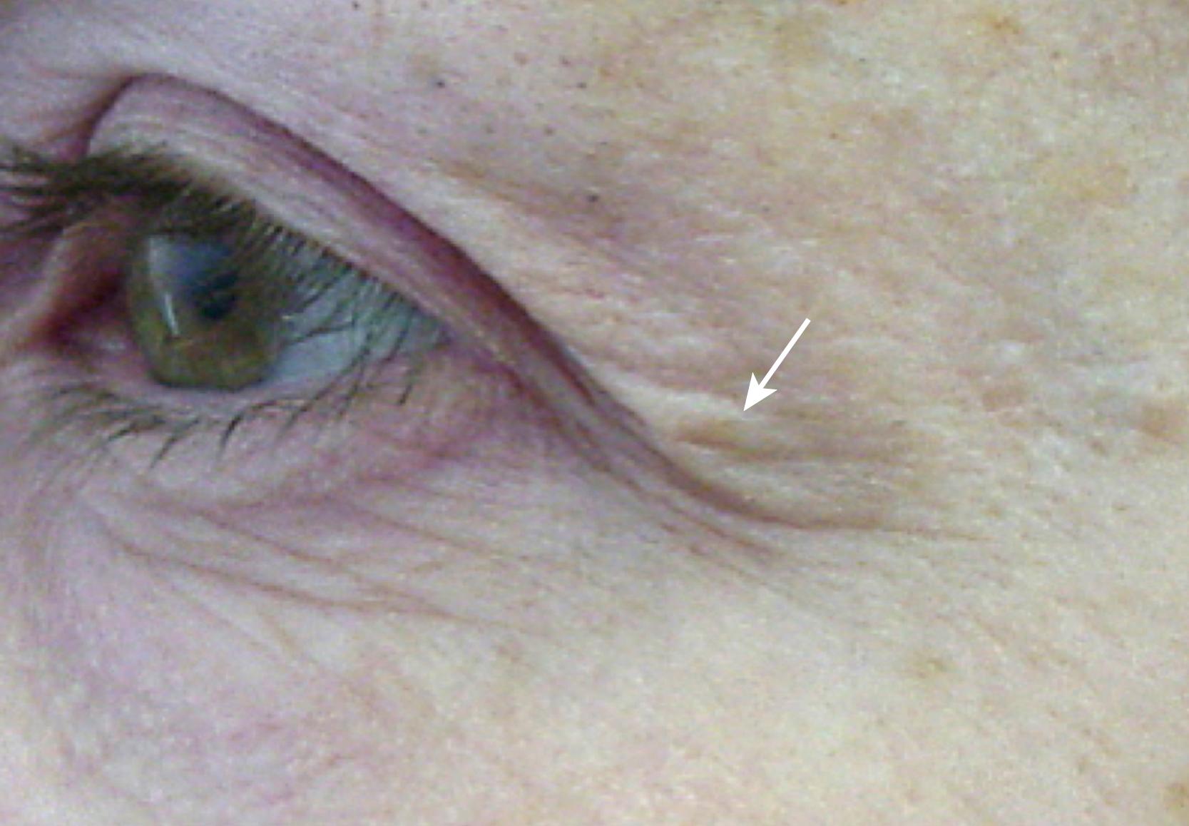 Fig. 63.3, “Connell’s sign.” An upper lid skin fold that extends off the eyelid and onto the lateral periorbital area is a key sign that forehead ptosis is present and an important finding in differentiating forehead from eyelid problems. In many cases this sign will be evident only after the patient’s forehead is relaxed and their brow descends to its resting position. For this reason it is important to examine the patient’s forehead in repose with the frontalis relaxed.