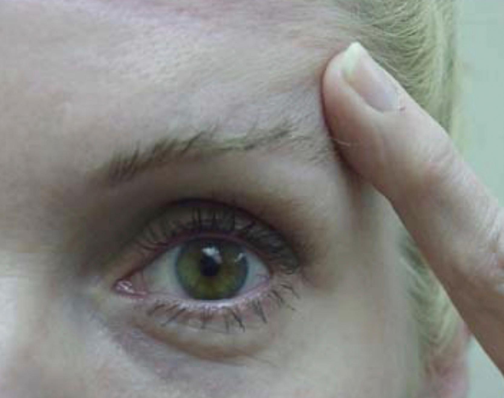 Fig. 63.4, “Flower’s sign.” Frequently, patients will unknowingly signal the need for forehead surgery during their consultation by holding up their eyebrow with a fingertip while requesting eyelid surgery.