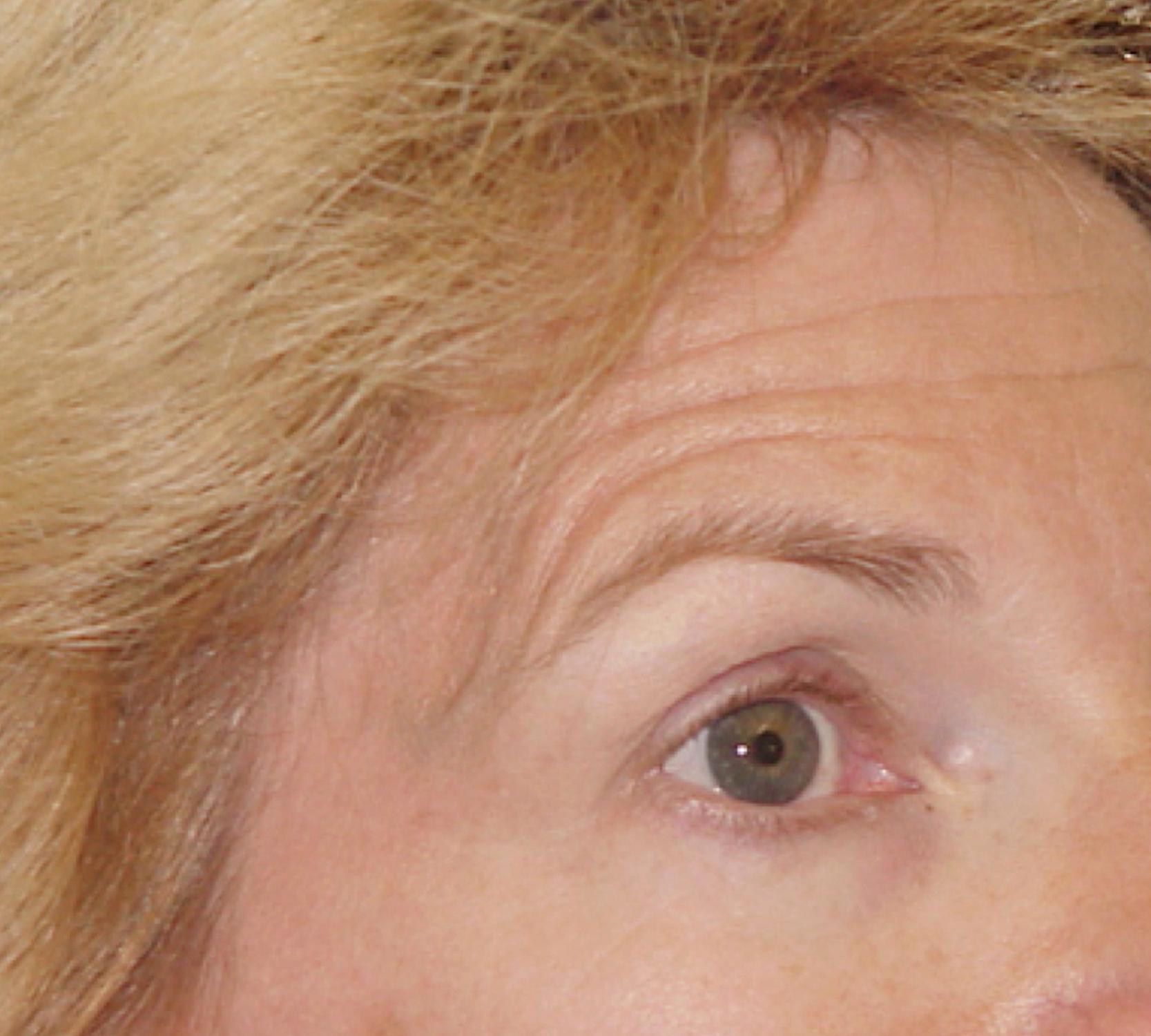 Fig. 63.5, Brow ptosis disguised by eyebrow raising . Patients often optimize their appearance when looking at their reflection by unconsciously raising their eyebrows. The all too commonly observed circumstance is one in which the patient with marked frontalis spasm and marked transverse forehead wrinkling holds a hand mirror during their consultation and sees only that their eyebrows appear to be in a normal position. In these situations it is essential that the surgeon explain the dynamics at work, and that forehead ptosis is present.