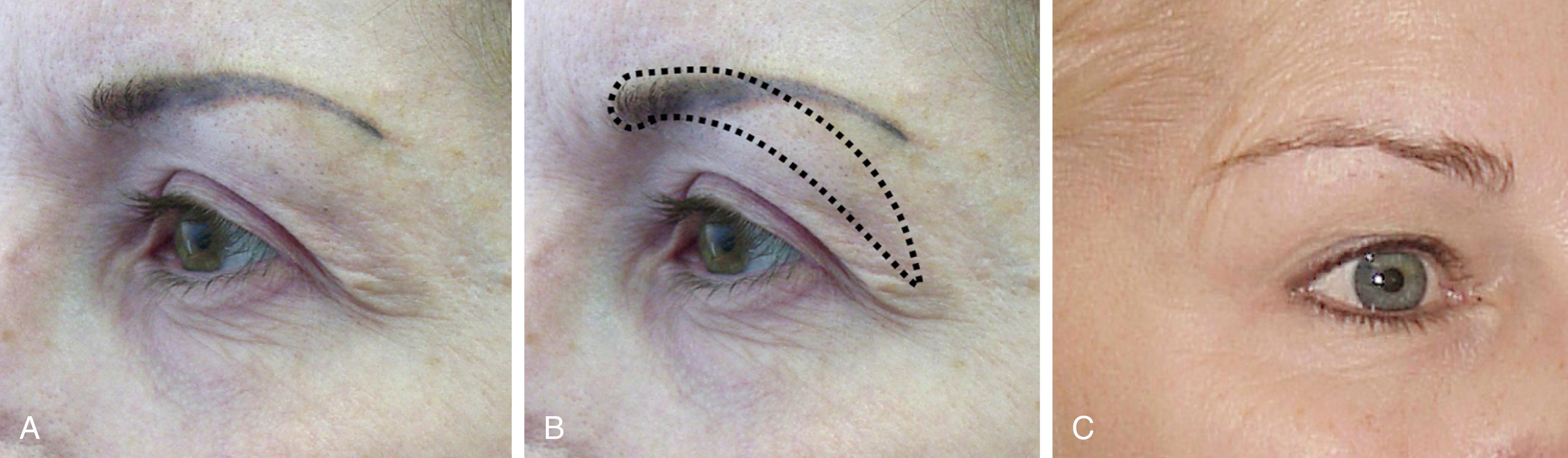 Fig. 63.6, (A,B) Do these patients have brow ptosis? (A) A patient whose eyebrow ostensibly appears to be in good position and configuration. A closer look shows that Connell’s sign can be seen (see Fig. 63.3 ), indicating that brow ptosis is present. Even closer consideration shows that the patient’s eyebrow is merely applied make-up and that the lateral part of her eyebrow has been plucked or shaved to hide its ptotic position (see also B). (B) In the same patient the dashed line shows the actual position of the eyebrow and the portion that has been plucked or shaved off. (C ) A different patient who upon casual consideration appears to have good eyebrow position and configuration. A closer look shows she has chronic frontalis spasm and upper lateral forehead transverse wrinkles indicating that forehead ptosis is present. On yet closer examination it can be seen that the inferior portion of her lateral eyebrow has been plucked or shaved, giving the illusion that it is higher than it really is. This patient has brow ptosis and needs forehead surgery even though her eyebrow position appears to be normal. If isolated upper blepharoplasty is performed the stimulus for eyebrow raising will be removed, the frontalis will relax, and the eyebrow will drop. A well-performed foreheadplasty will fix her brow in the position she is holding it and her eyebrow may appear to be in the same position after surgery as before but the frontalis will relax and transverse forehead wrinkling will not be present.