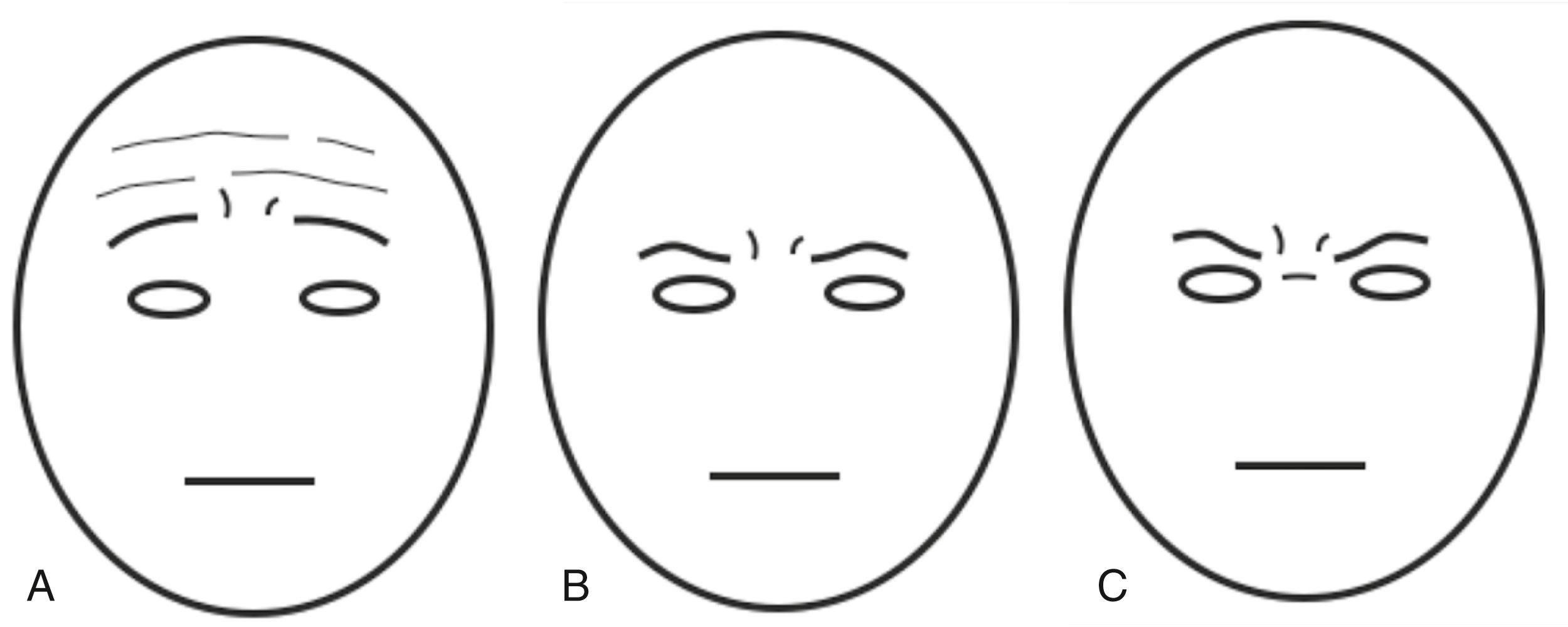 Fig. 63.7, Forehead aging and inappropriate expressions. (A) Typical appearance of patient with forehead aging and blepharochalasis before surgery. In an effort to clear upper-lateral visual field obstruction the patient uses frontalis muscles to hold up the eyebrows. Because the majority of the frontalis muscle is situated medially, this produces an exaggerated elevation of the medial eyebrow. Eyebrow elevation, in conjunction with corrugation of the forehead, results in a sad, tired, and melancholic appearance. Note that glabellar frown lines in this situation do not appear menacing and add a pained element to the melancholic appearance. (B) Typical appearance of a patient with unrecognized forehead ptosis after upper blepharoplasty alone. Upper blepharoplasty has removed the eyelid skin that provided the stimulus for frontalis muscle action, the frontalis has relaxed, and the full extent of forehead ptosis is now evident. This results in a lowering of the eyebrows. Note that the glabellar frown lines now convey a stern or angry appearance. (C) Same face and circumstances as in (B) but with the addition of a transverse upper nasal crease. Chronic procerus contraction amplifies an angry appearance and creates a look of disapproval and aggression.