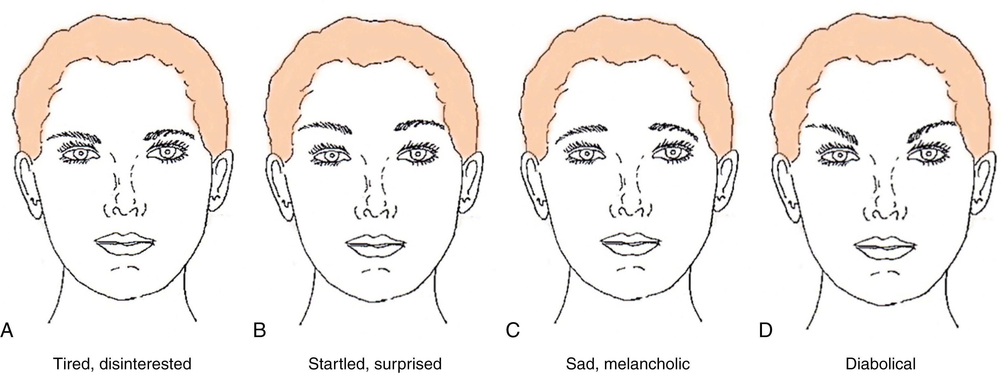 Fig. 63.8, Eyebrow position and configuration and its influence on expression. Many of the changes that occur naturally with age in the forehead resemble features of certain expressions, and these changes may thus be misinterpreted by others who instinctively, but mistakenly, assume we feel the way we look. Because of this, the aging face may appear inappropriately tired, disinterested, angry, disapproving, distressed, sad or conniving, even if the individual is not. (A) A prototypical face with a low, flat eyebrow. The face appears tired and disinterested. (B) A prototypical face with a high, elevated medial and lateral eyebrow. The face appears startled and surprised. (C) A prototypical face with a low, lateral and high medial eyebrow. The face appears sad and melancholic. (D) A prototypical face with a high lateral and low medial eyebrow. The face appears devilish and diabolical.