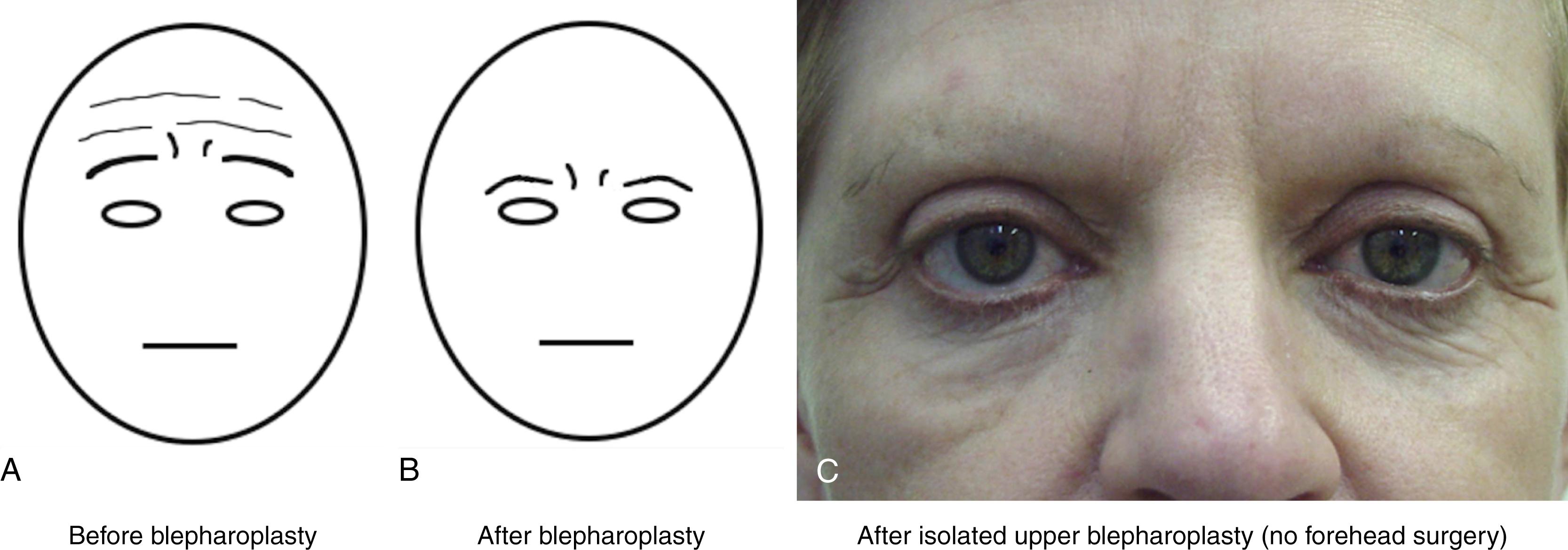 Fig. 63.9, Eyebrow position and configuration and their influence on expression. Mistaken attempts to treat pseudoblepharochalasis with an isolated blepharoplasty alone when significant forehead ptosis is present usually results in a loss of the stimulus for brow elevation, descent of the eyebrow as the frontalis muscle relaxes, and the reappearance of a pseudo skin excess in the lateral orbit. This, in turn, results in an exacerbation of a sad, tired or disinterested appearance. (A) Schematic of face with forehead ptosis. Brow skin resting on the eyelid triggers frontalis activation and the surgeons and patient may erroneously think that brow ptosis is not present. (B) Schematic of face of patient with unrecognized brow ptosis after isolated blepharoplasty. The stimulus for frontalis activation has been removed and the brow drops. The face takes on a tired, sad, and disinterested appearance. Often it appears as if eyelid skin had not been removed. (C) Patient example of sequence of events seen in (A) and (B). While the surgeon was technically successful at removing upper eyelid skin, the eyebrows sit in a low position and an unesthetic configuration, and the procedure is an artistic failure.