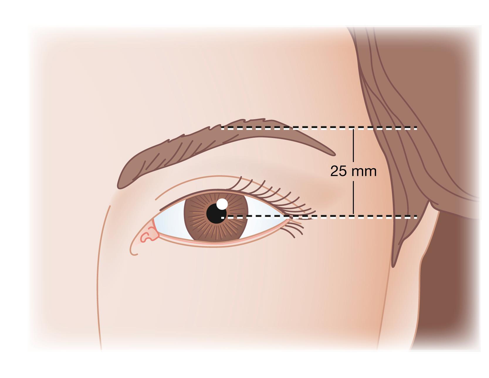 Fig. 63.10, Traditional guideline for attractive eyebrow position. Traditionally, surgeons have defined attractive eyebrow height in simple linear and absolute terms and often it is said that the eyebrow should sit 25 mm over the mid-pupil in relaxed forward gaze. While convenient, and useful to some extent, any such analysis is intrinsically flawed in that rigid linear measurements are ultimately inaccurate in as much as they assume each subject’s head and facial features to be the same.