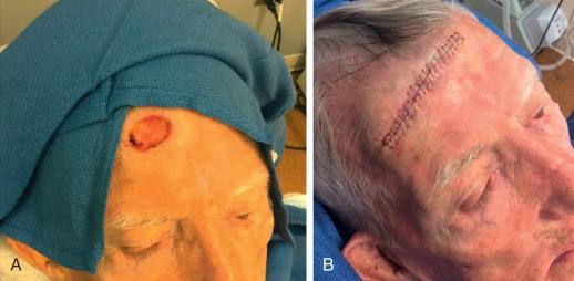 Fig. 11.8, Horizontal closure. One of the most commonly utilized closure for the forehead is the horizontally oriented linear closure. This is optimally used for defects that are situated higher on the forehead. (A) Defect. (B) Repair.