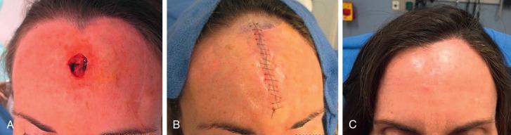 Fig. 11.9, Vertically oriented linear closure on the forehead can be an option for defects that cannot be closed horizontally within frontalis generated relaxed-skin tension lines (RSTLs) without causing free margin distortion. (A) Defect. (B) Closure. (C) Four-month follow-up.