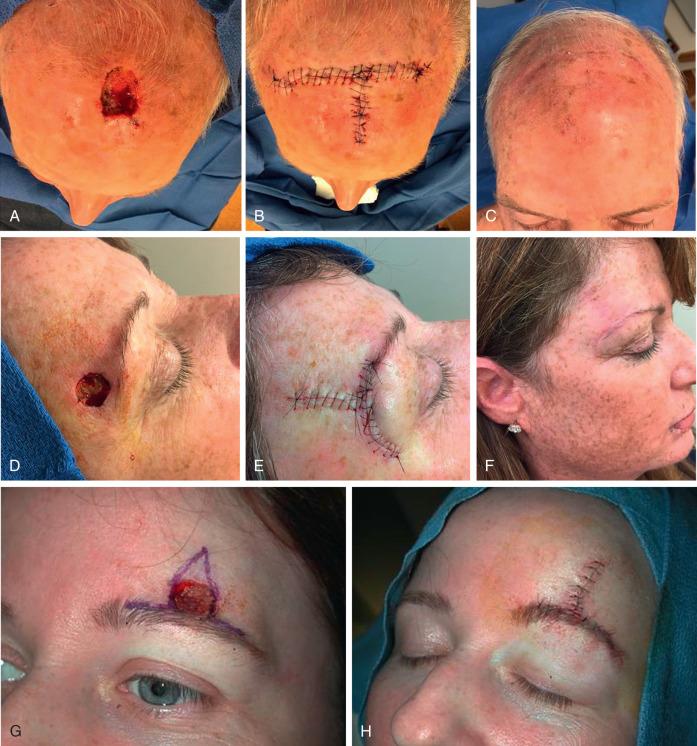 Fig. 11.11, A-to-T advancement flaps. (A) Defect on the border of forehead and scalp. (B) Repair. (C) Three-month follow-up. (D) Defect on the lower lateral forehead. (E) Repair. (F) Three-month follow-up. (G) Defect on the mid eyebrow border. (H) Repair.