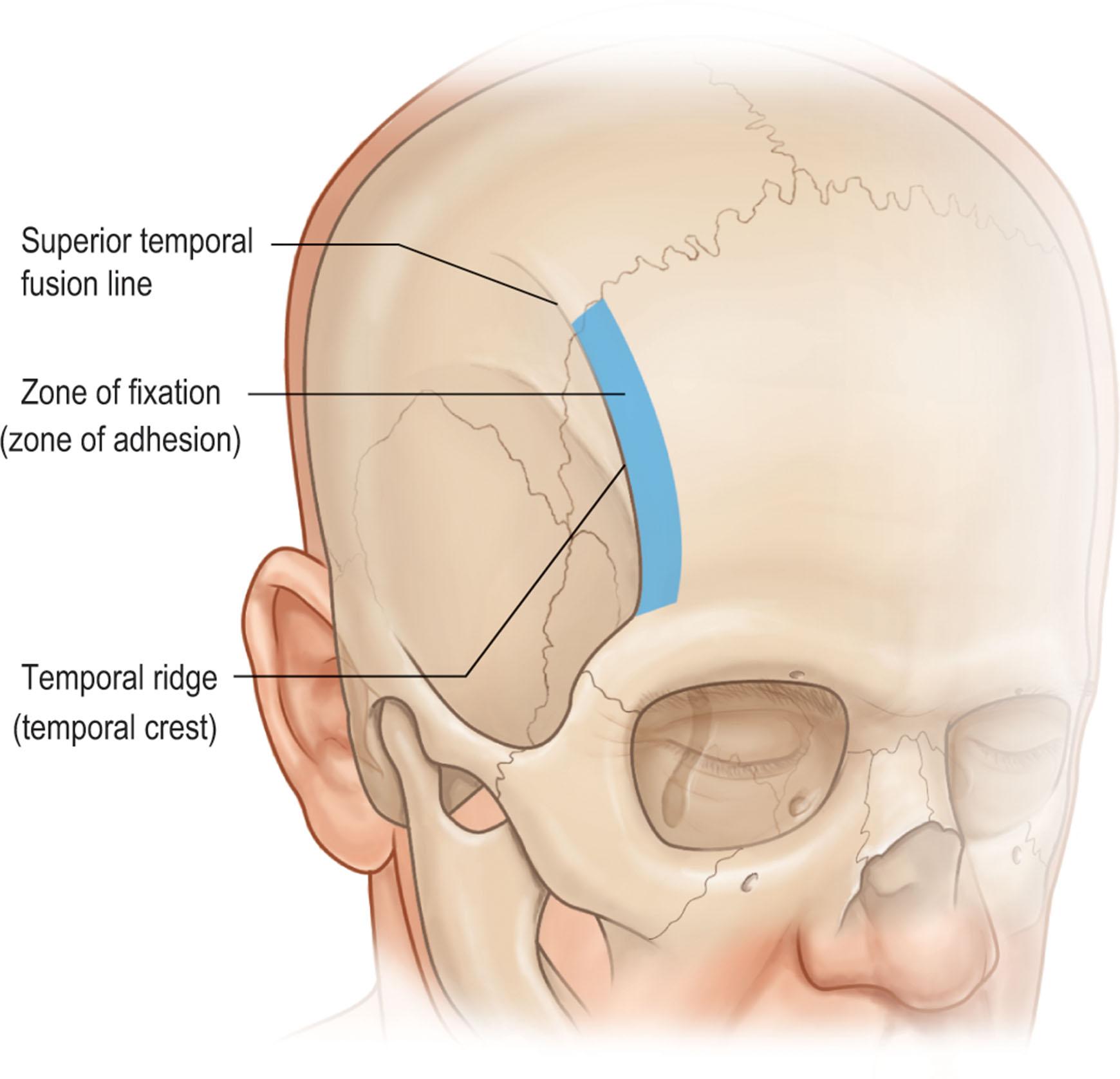 Figure 11.1, Bony anatomy of the forehead and temporal fossa. The palpable temporal ridge separates the temporal fossa from the forehead. The zone of fixation (also called zone of adhesion, superior temporal septum) is a 5-mm-wide band along the temporal ridge where all layers are bound down to periosteum.