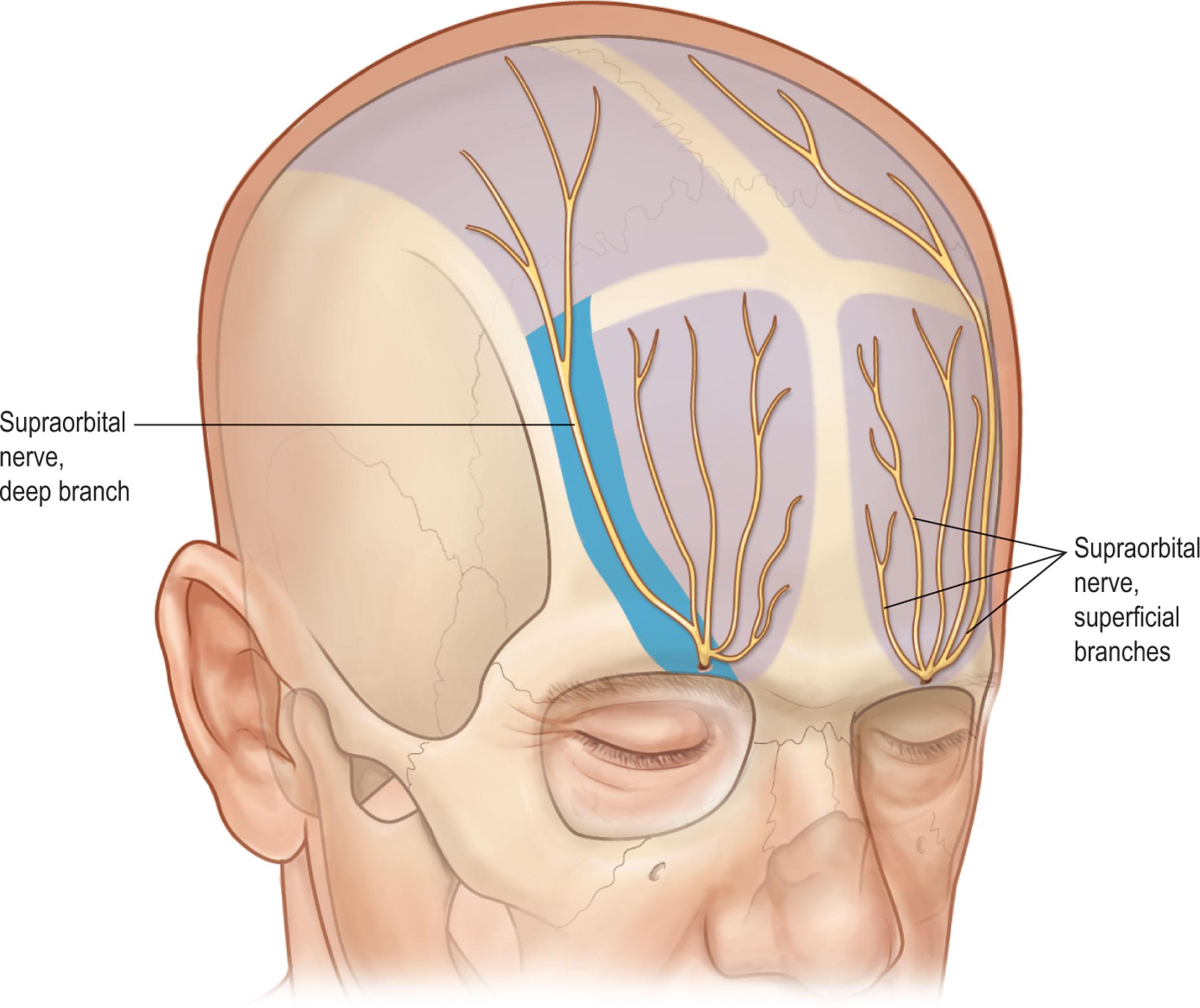 Figure 11.11, The deep branch of the supraorbital nerve travels in a 1-cm-wide band between 5 and 15 mm medial to the temporal ridge.