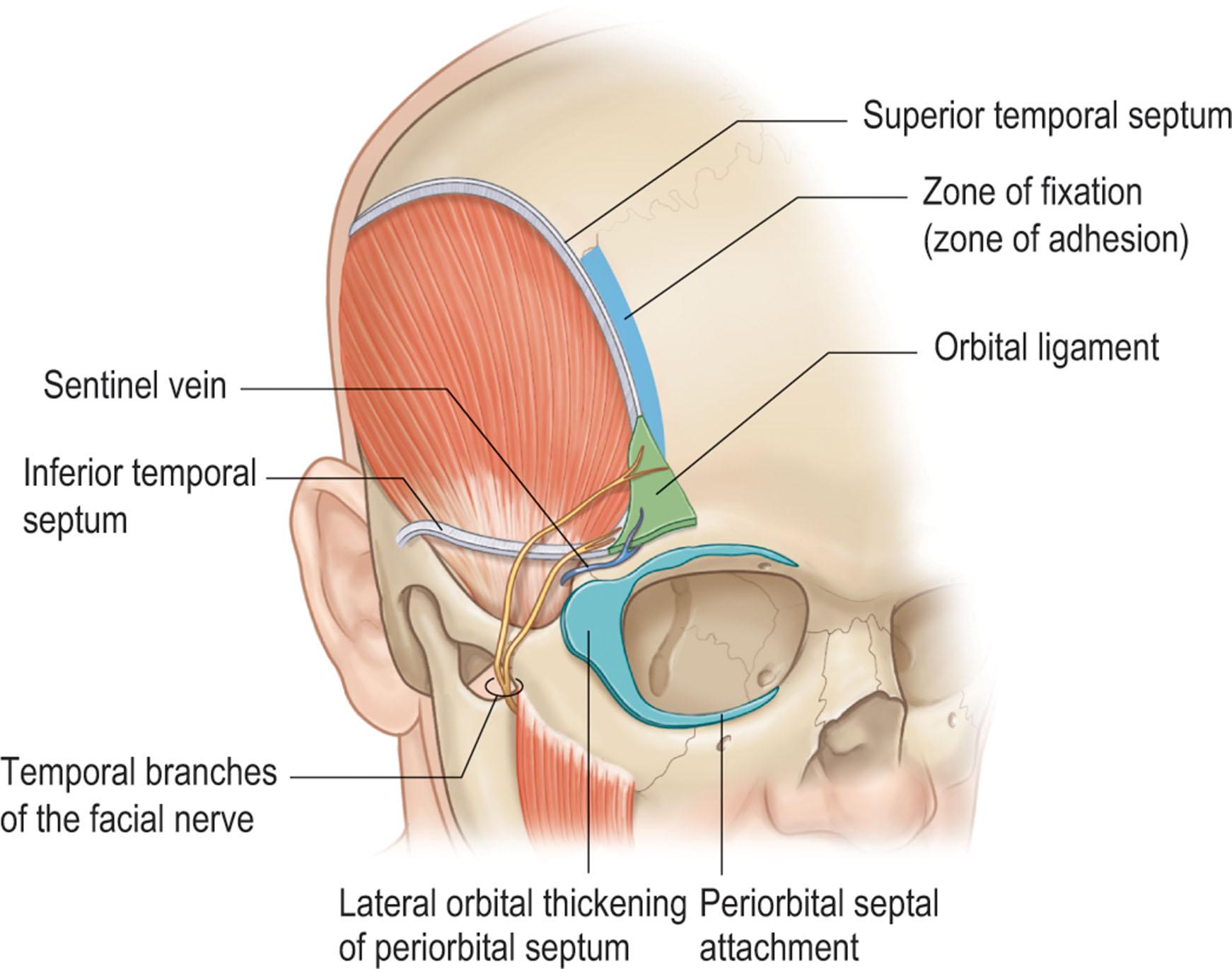 Figure 11.2, Fascial attachments around the orbital rim. The inferior end of the zone of fixation is the orbital ligament. The lateral orbital thickening is a lateral extension of the septum that extends across the lateral orbital rim onto deep temporal fascia.