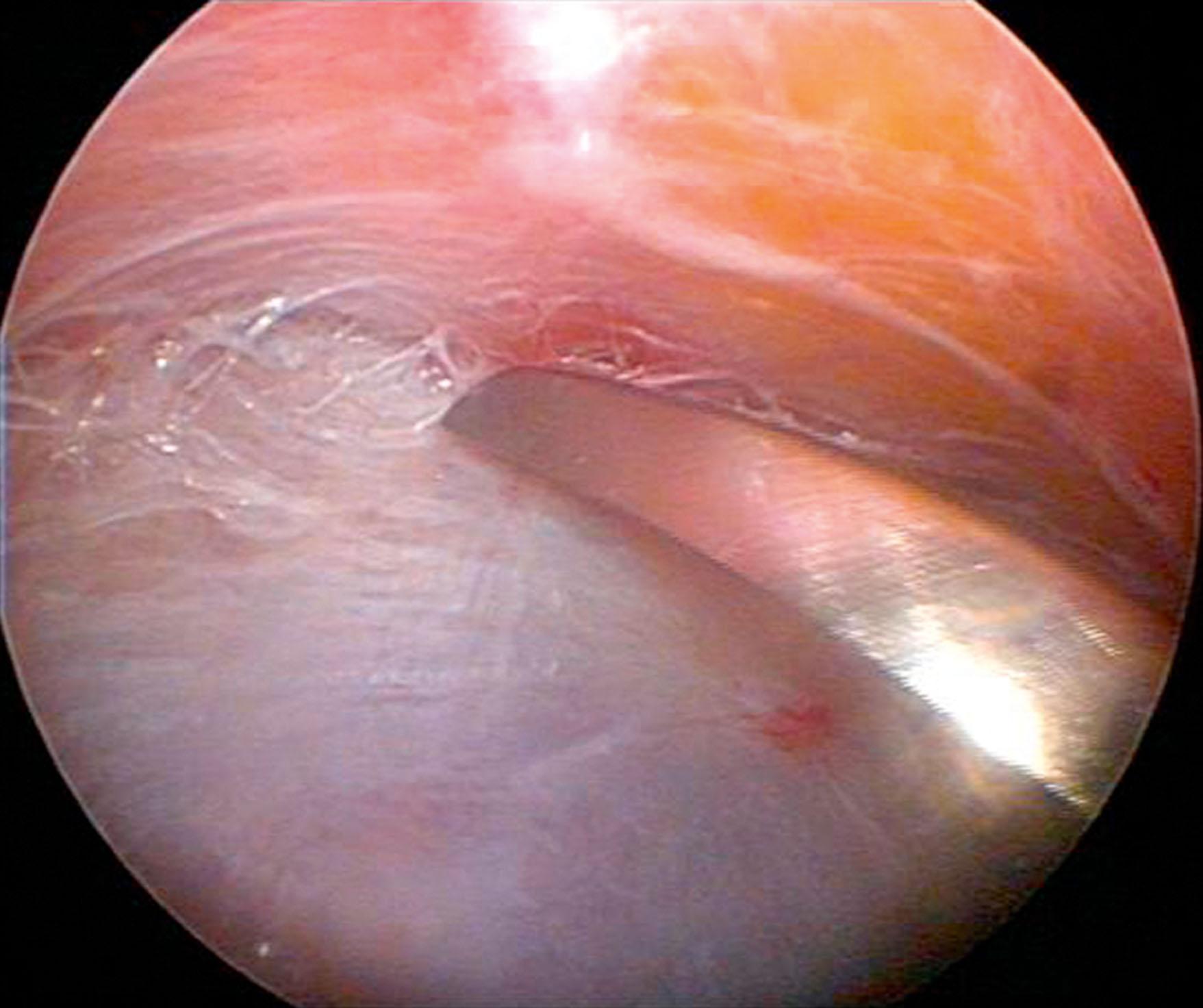 Figure 11.3, Endoscopic view of the inferior temporal septum, right side.