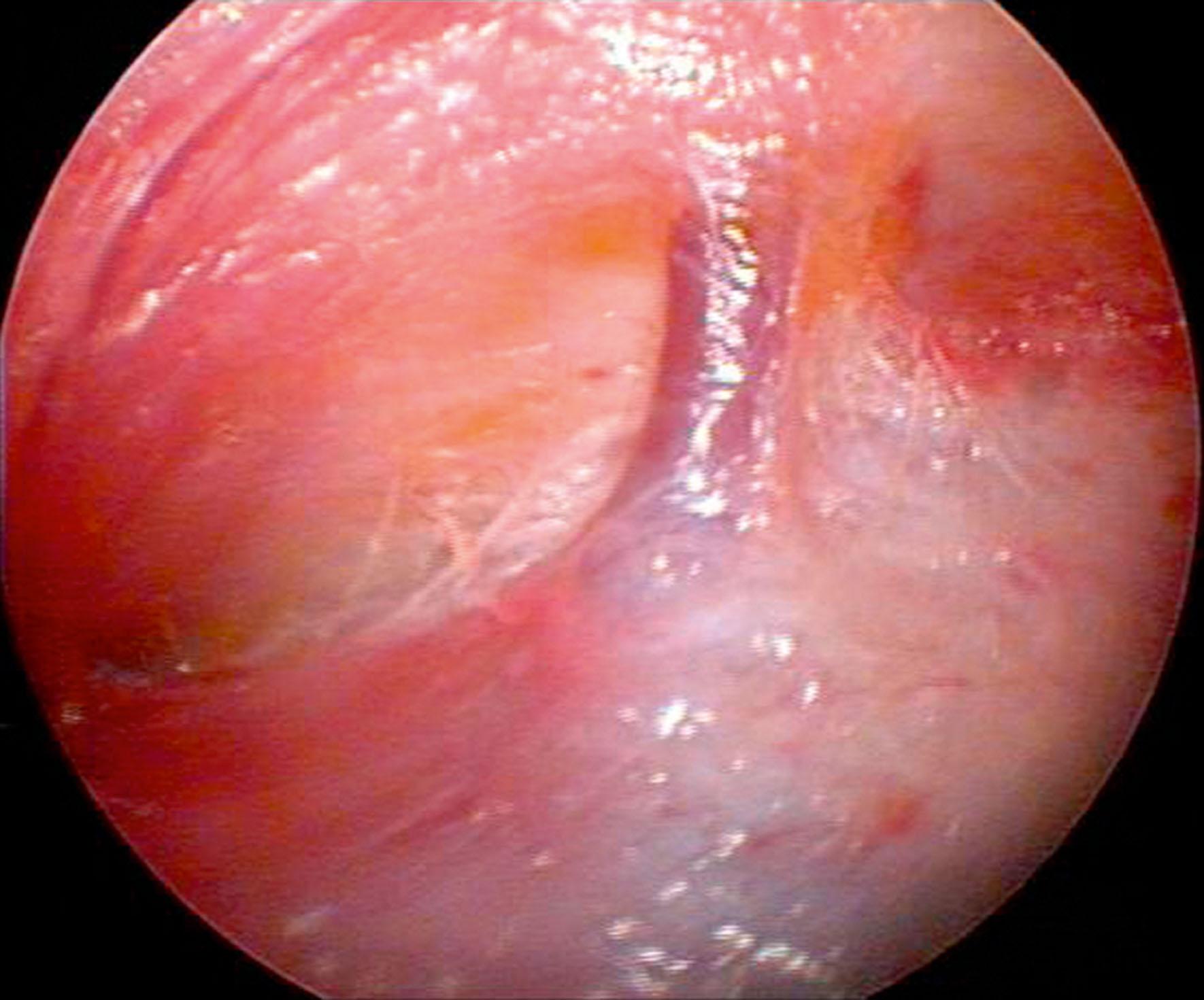 Figure 11.4, Endoscopic view of the medial zygomaticotemporal vein (sentinel vein), right side.