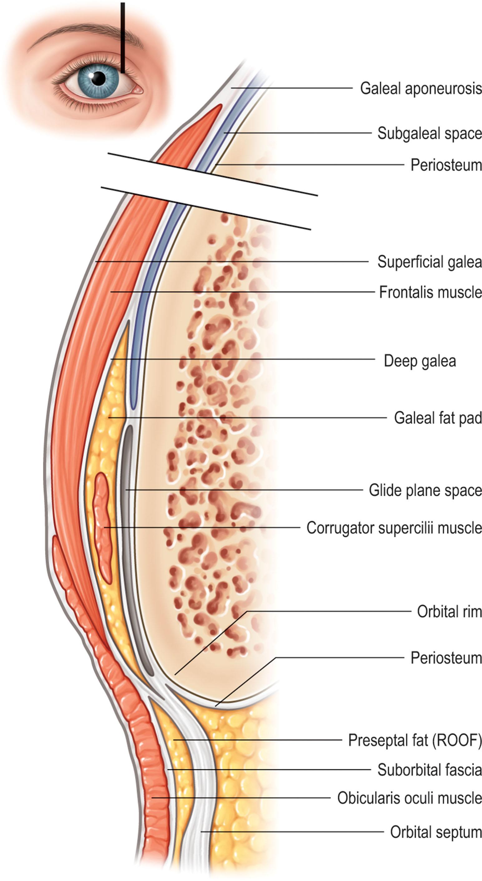 Figure 11.5, Relationship of galea to surrounding tissue as it splits to encompass the frontalis muscle, the galeal fat pad, and the glide plane space. The corrugator supercilii traverses through the galeal fat pad as it courses from its deep bony origin to its superficial insertion in the orbicularis and dermis.