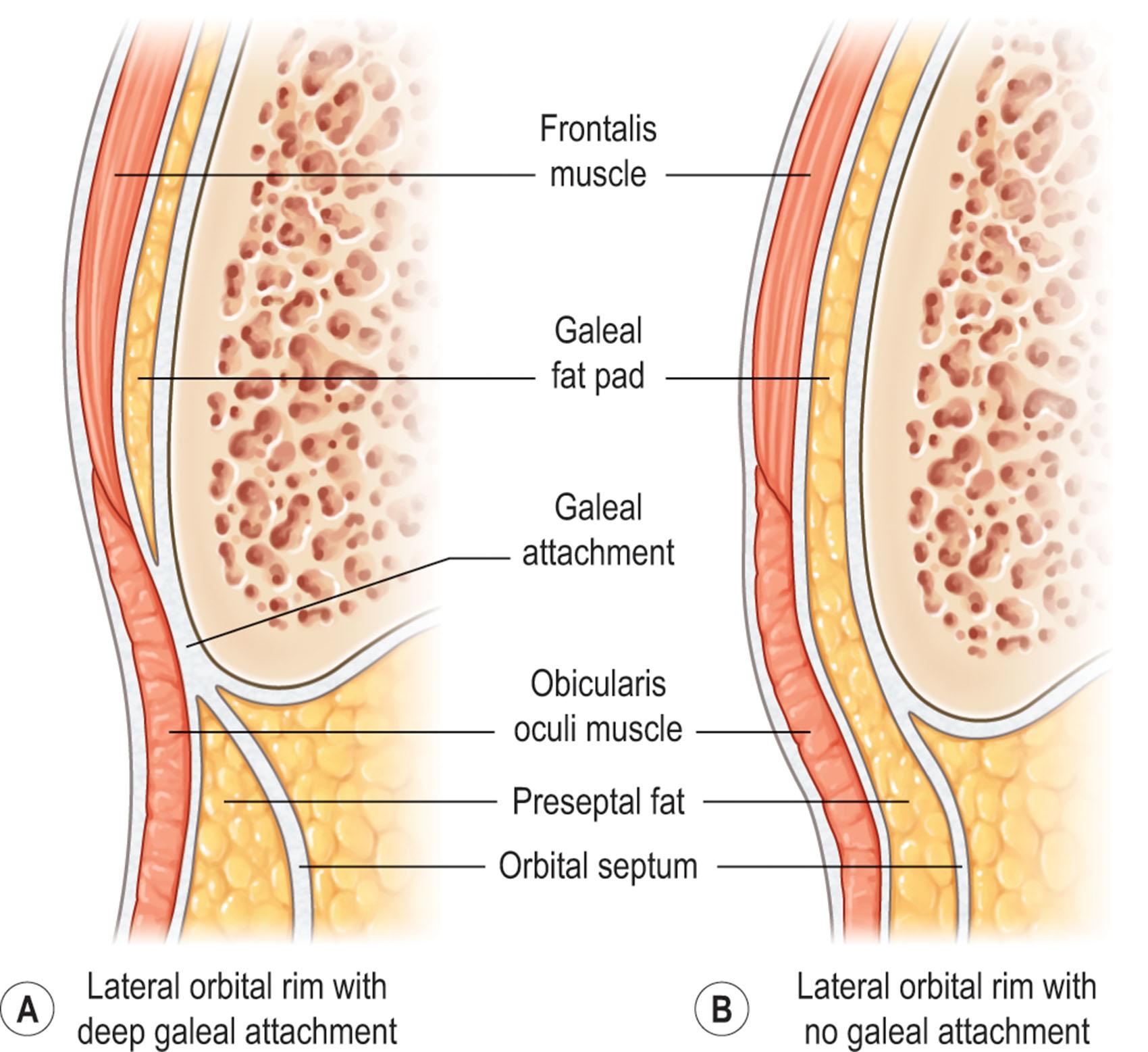 Figure 11.6, Lateral orbital rim variation. (A) Galeal attachment tethers the overlying brow. (B) The galeal fat pad is contiguous with retro-orbicularis oculi fat, potentially making the lateral brow prone to ptosis.