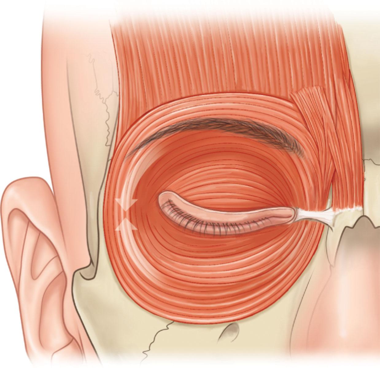 Figure 11.8, Lateral orbicularis acts like a sphincter, depressing the lateral brow.