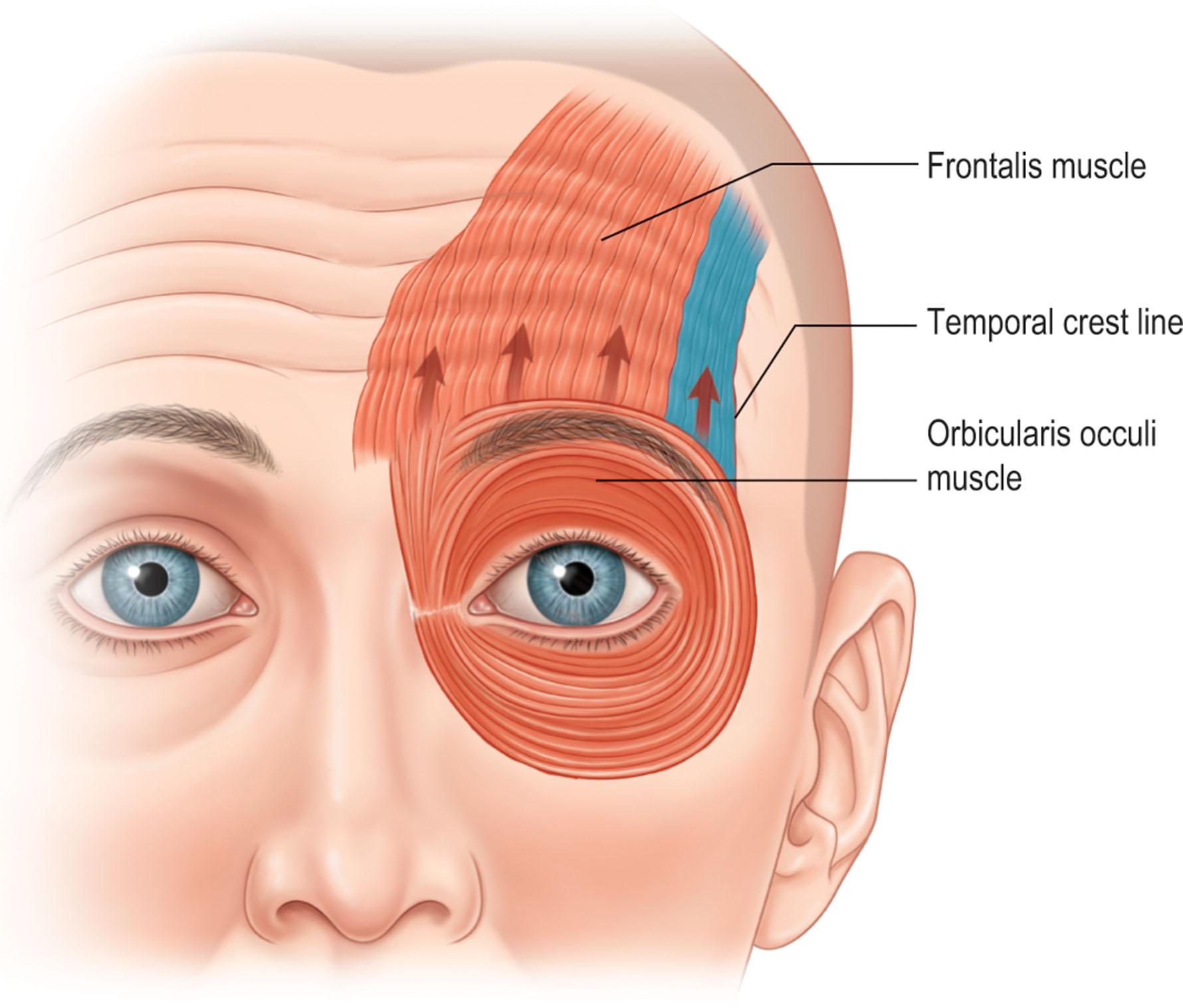 Figure 11.9, Frontalis acts to raise the eyebrow complex. On contraction, most movement occurs in the lower third of the muscle, and action is strongest on the medial and central eyebrow.