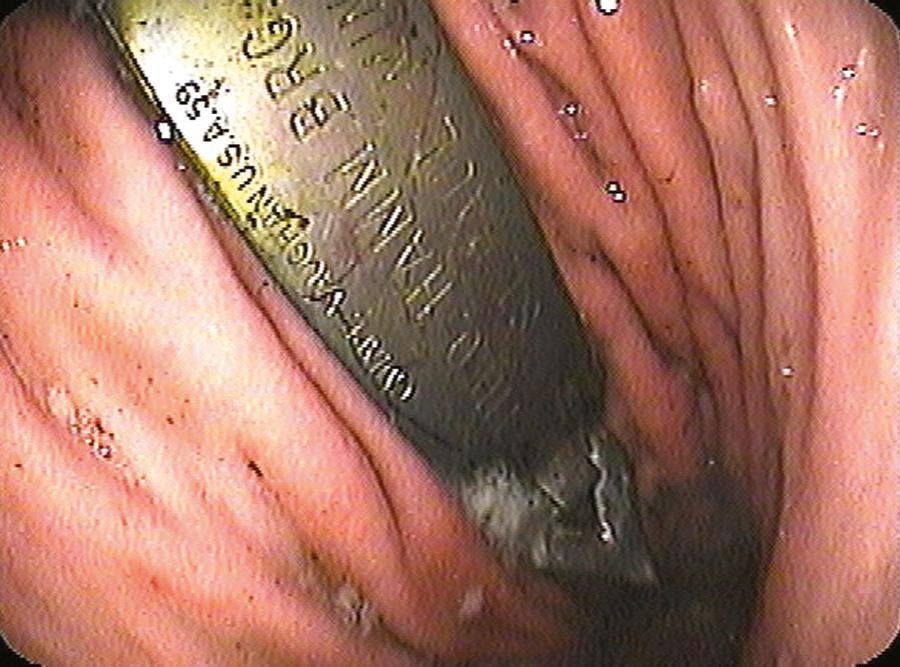 Fig. 28.1, Endoscopic image of a bottle opener (in the stomach) ingested by an intoxicated patient.