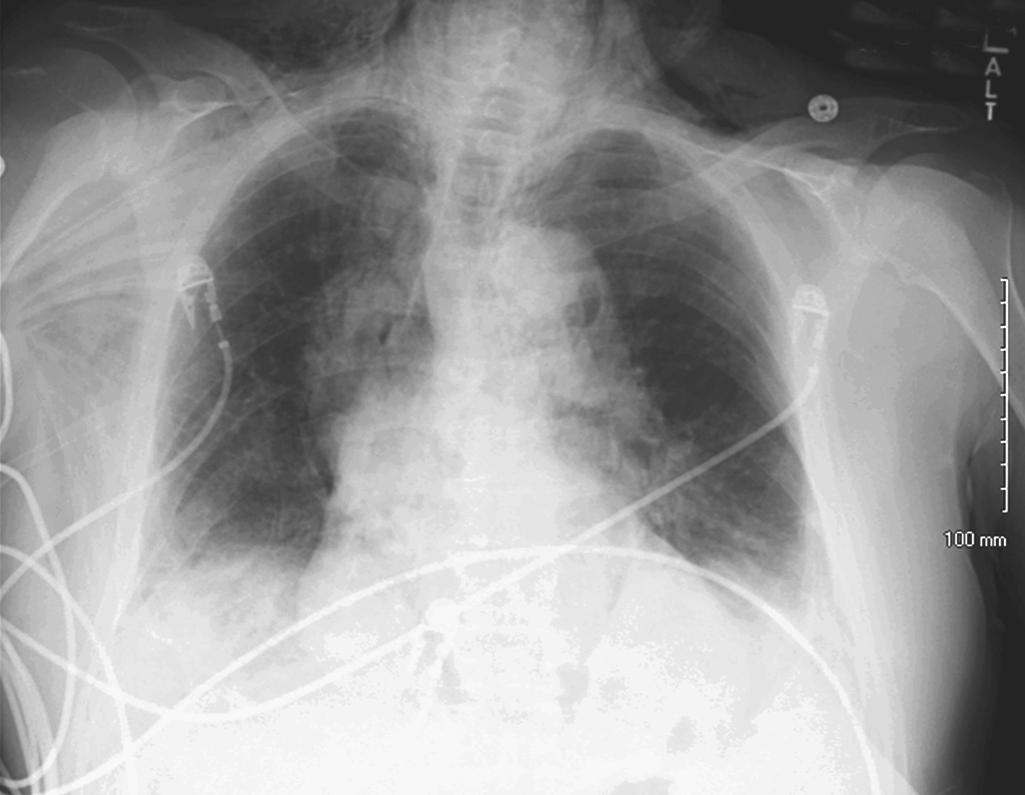 Fig. 28.4, Chest film demonstrating pneumomediastinum and bilateral pneumothoraces in a patient who developed esophageal perforation secondary to a food impaction left untreated for longer than 24 hours.