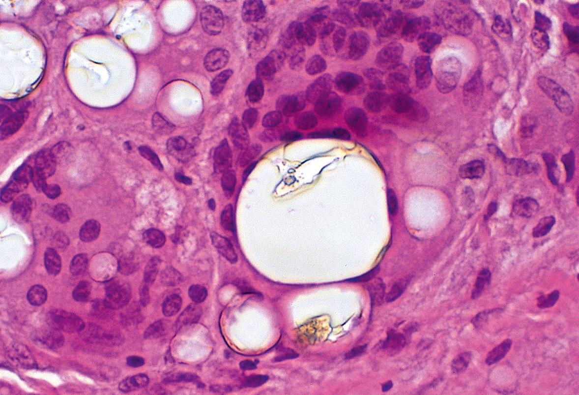 Fig. 94.2, Birefringent foreign body is engulfed by a foreign body-type giant cell with the typical haphazard array of nuclei.