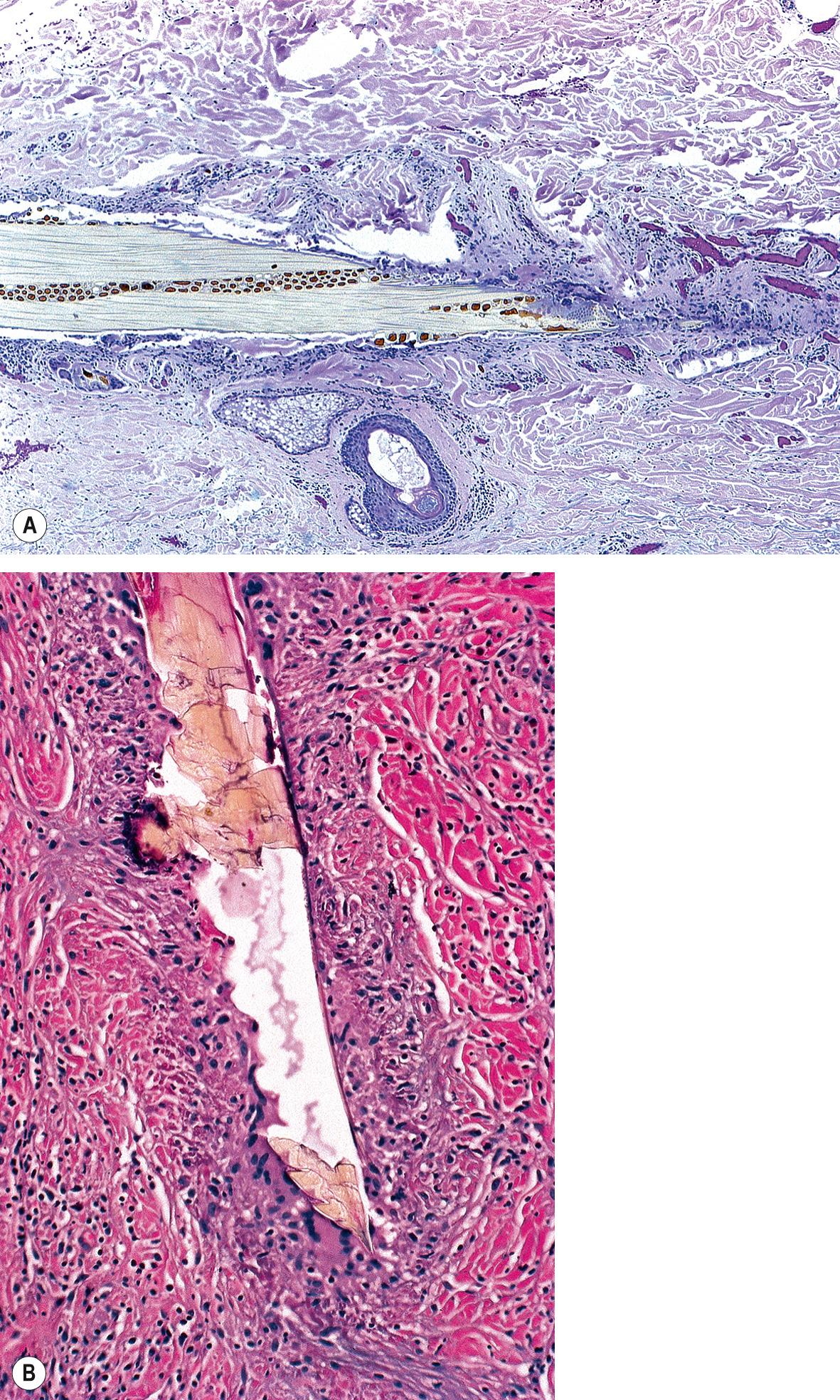 Fig. 94.3, Granulomatous foreign body reactions to implanted organic material.