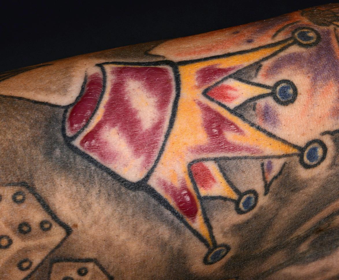 Fig. 94.6, Granulomatous reaction within the red portions of a tattoo.