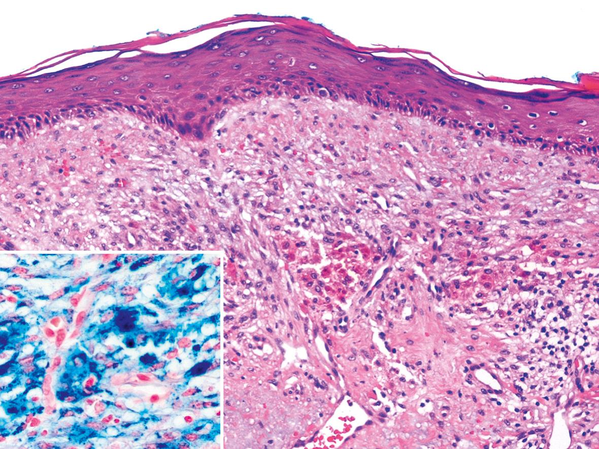 Fig. 94.7, Ferrous subsulfate (Monsel's solution) – iatrogenic tattoo and granulomatous reaction.