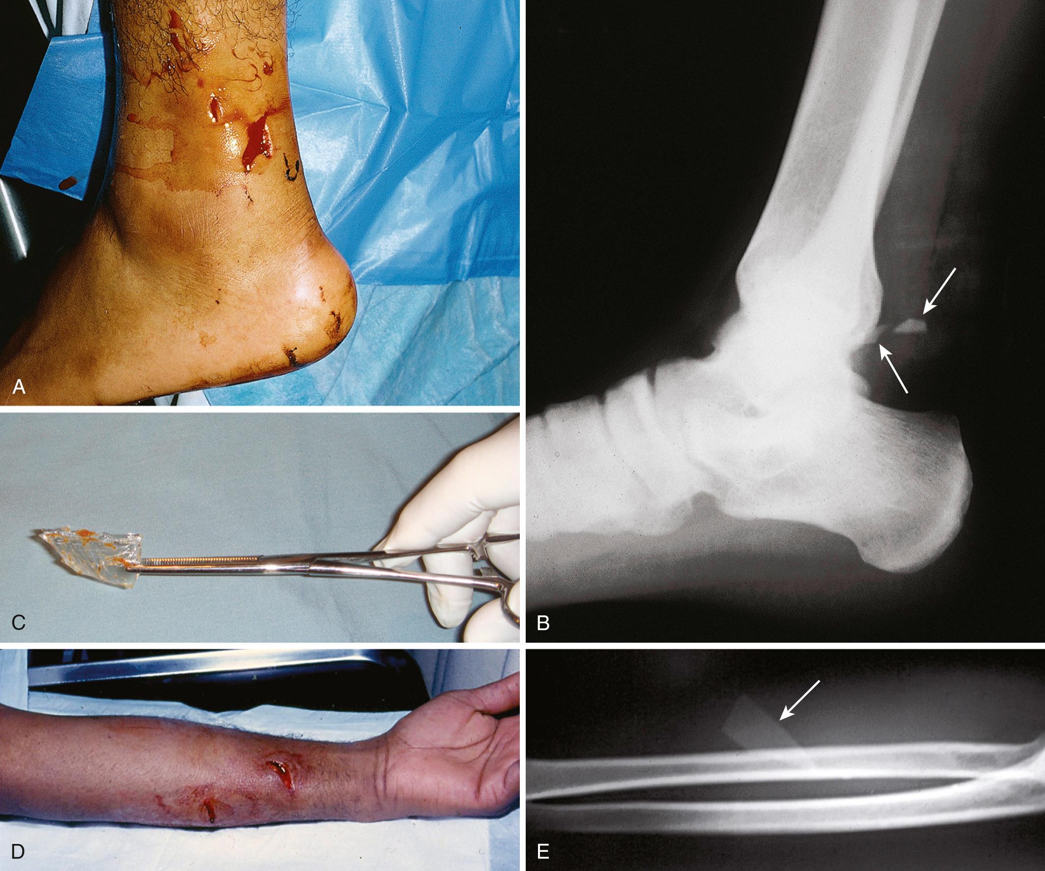Figure 36.2, Some wound mechanisms are classic for the presence of a foreign body (FB). Note that even small pieces of all types of glass are readily seen on a plain radiograph. A, This intoxicated patient kicked out a window and sustained seemingly minor puncture wounds. He did not believe that glass was in the wound, there was little pain, and no FB could be palpated externally. B, A radiograph revealed a large shard of glass (arrows) deeply embedded in the wound. C, The shard of glass was removed, but only after 20 minutes of exploration. D, Another classic scenario for a retained glass FB is putting the arm through a window. An FB was not suspected or sensed by the patient or clinician. E, When a radiograph was taken, a large shard of glass (arrow) was readily detected. Despite its size, removal was difficult and time-consuming.