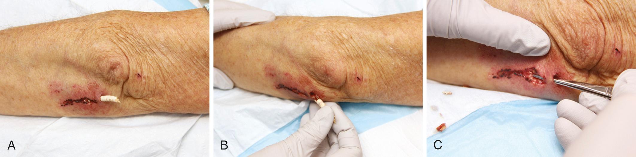 Figure 36.3, A, This patient has an obvious wooden foreign body (FB) on the dorsal aspect of the proximal part of the forearm. B, Manual removal of the object was not difficult. C, However, thorough exploration of the wound cavity via an incision over the entire length of the FB tract revealed multiple small wooden fragments. Wood fragments retained in a wound will always cause an infection. Proper exploration requires adequate analgesia, good lighting, hemostasis, and a cooperative patient. Use of a metal probe may help identify the foreign object by feel or sound (see Fig. 36.17 ).